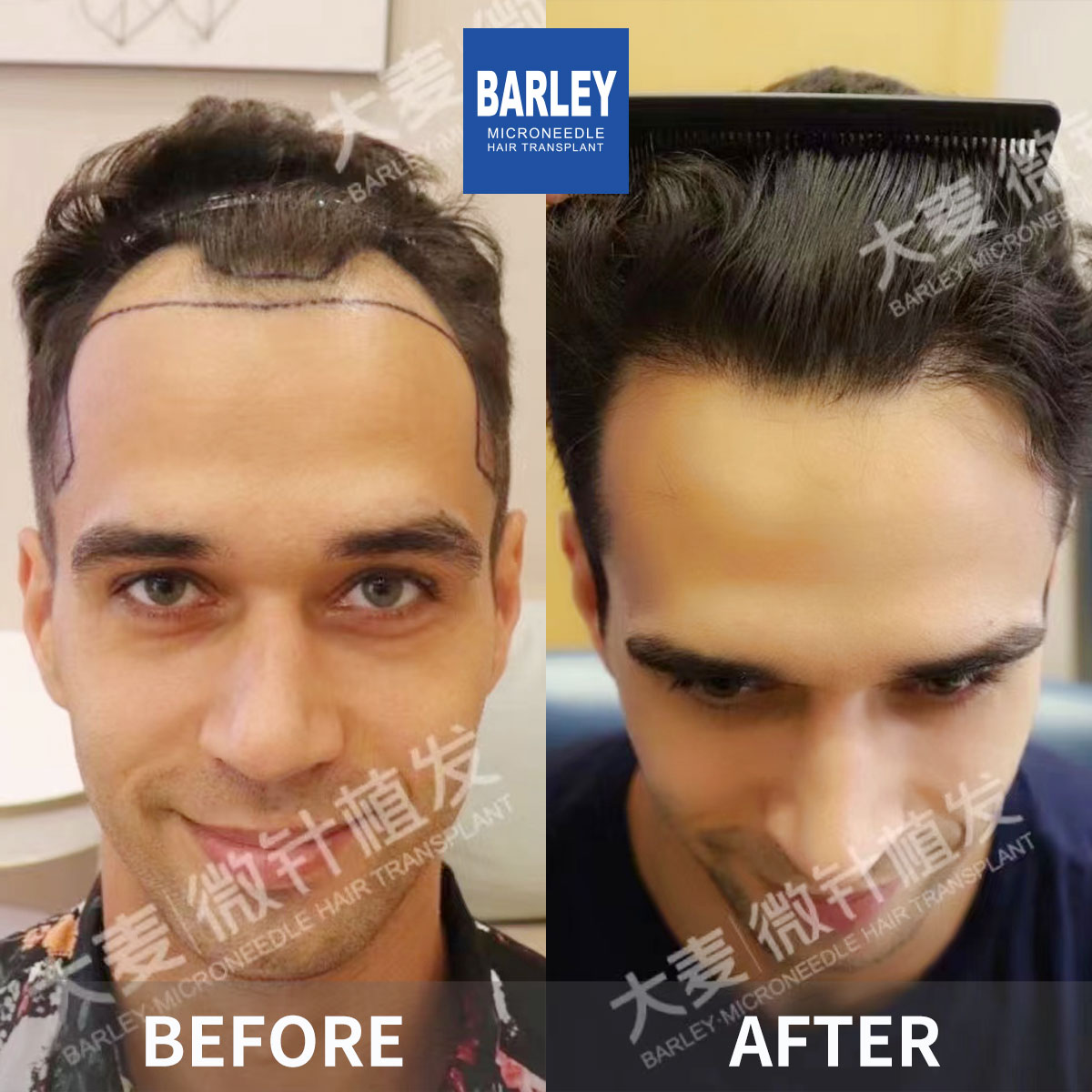Hairline Transplant Result