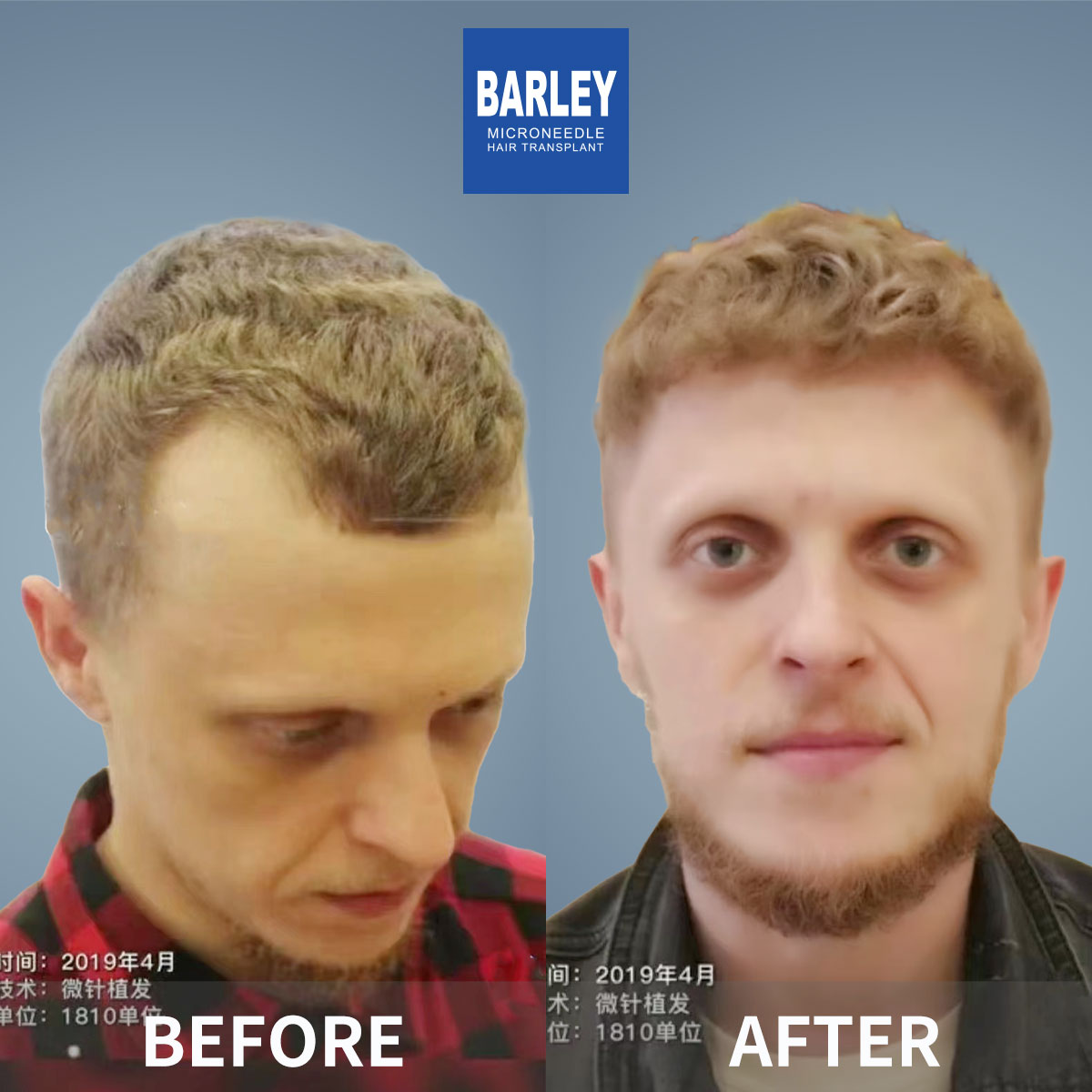 Hairline Transplant Result