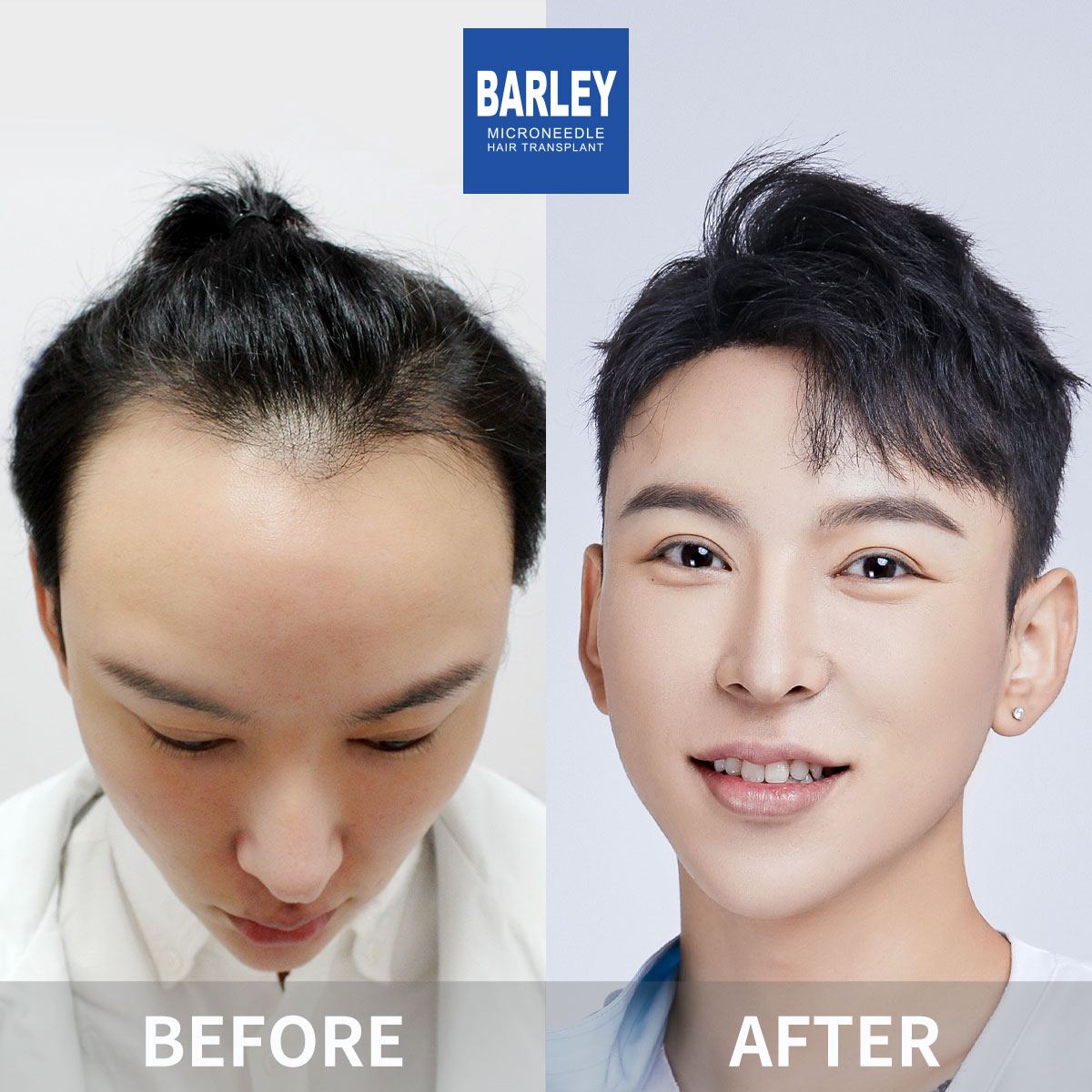 Hairline Transplant Result