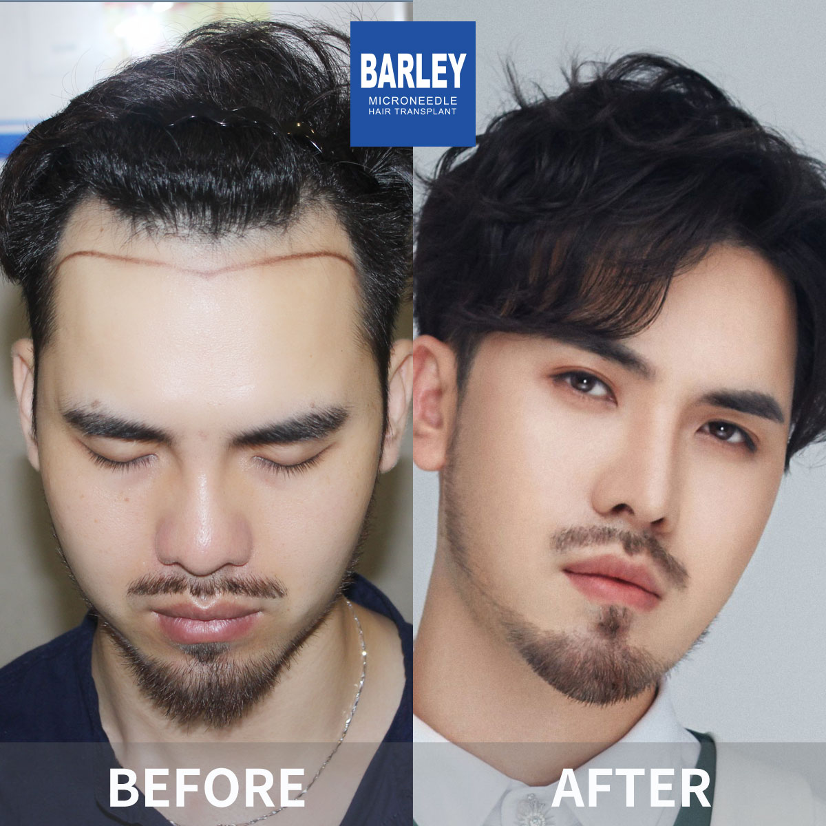 Hairline Transplant Result
