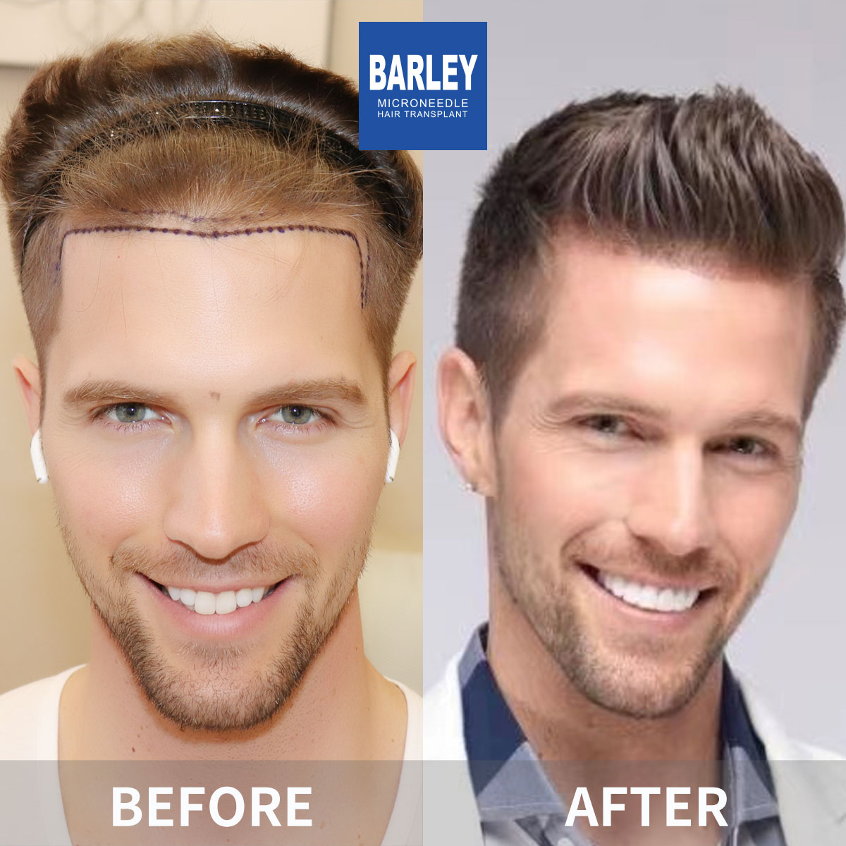 Male Hair Transplant