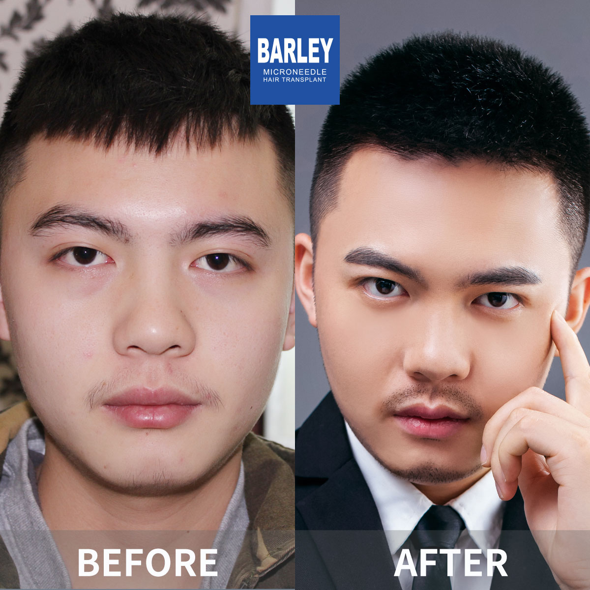 Hairline Transplant Result