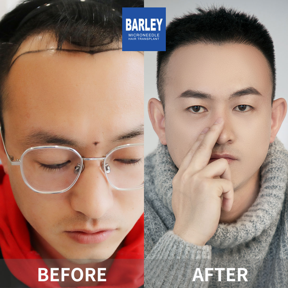 Hairline Transplant Result