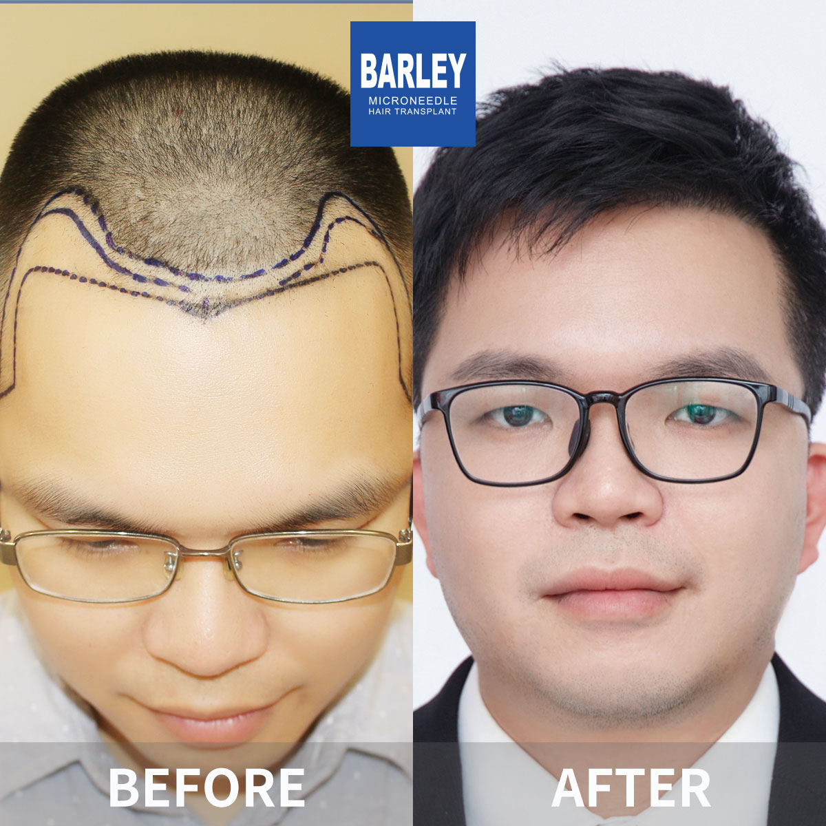 Hairline Transplant Result