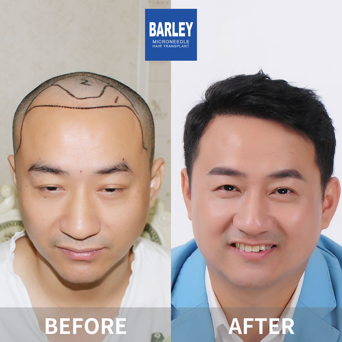 Hairline Transplant Result