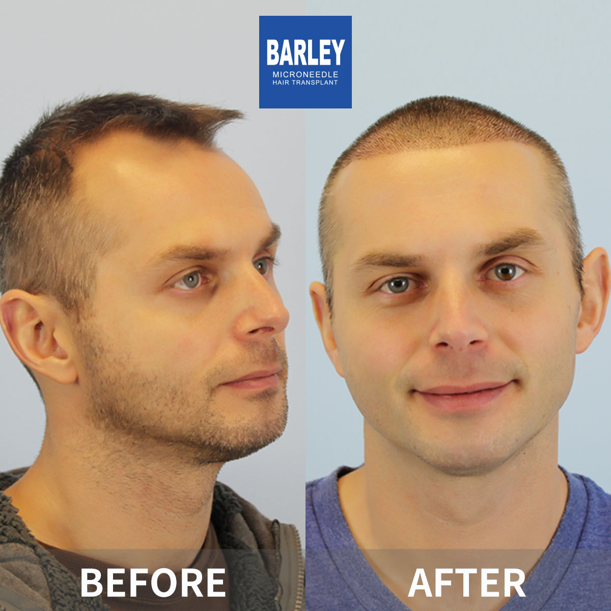 Hairline Transplant Result