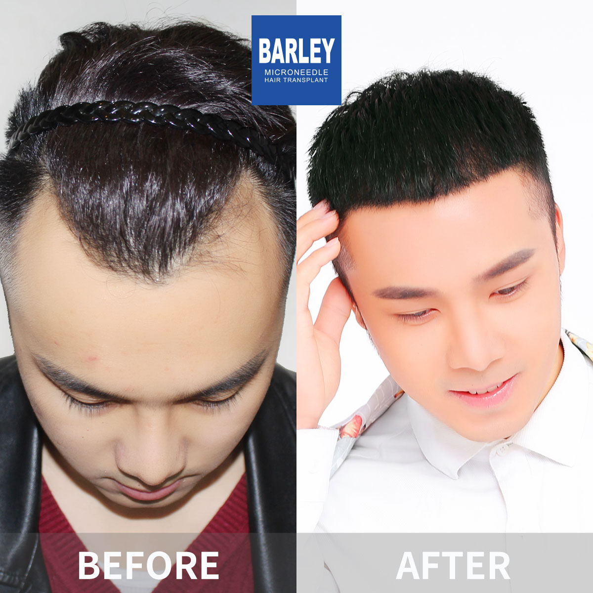 Hairline Transplant Result