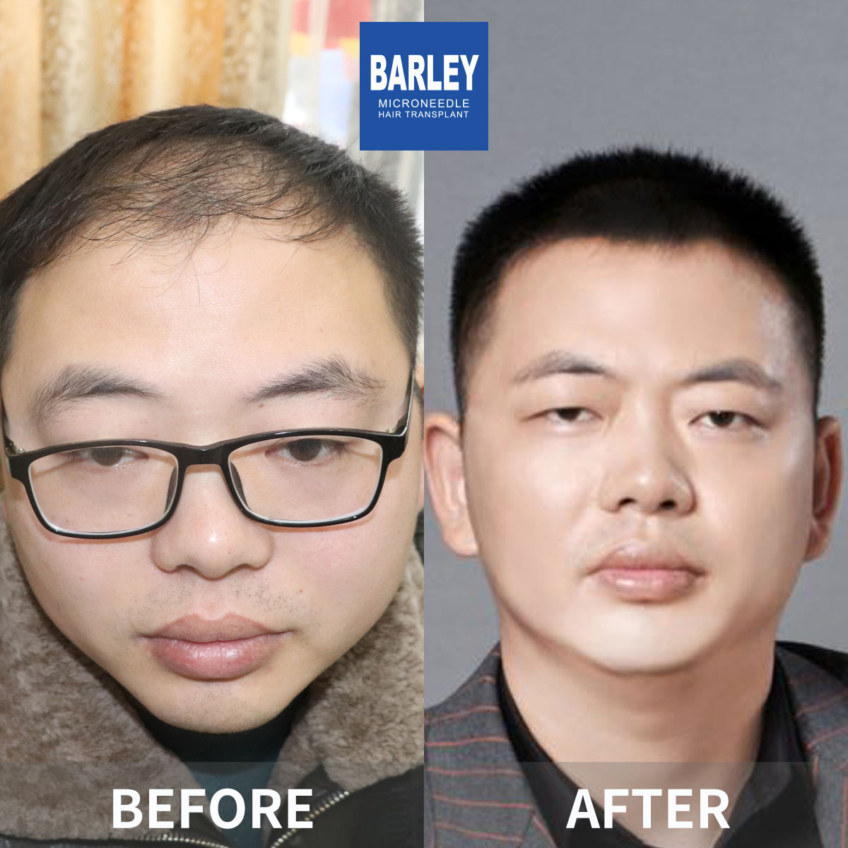 Hairline Transplant Result