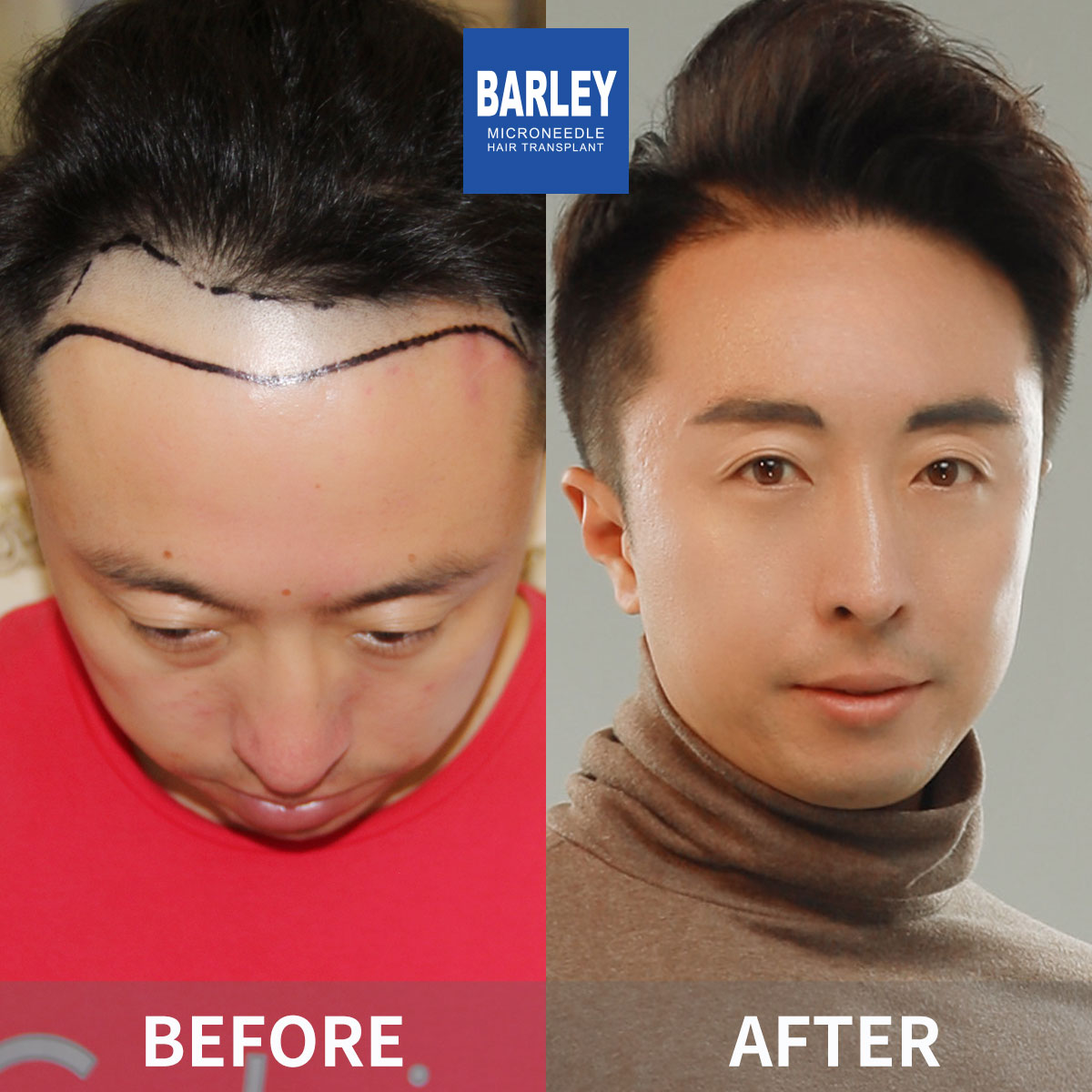 Hairline Transplant Result