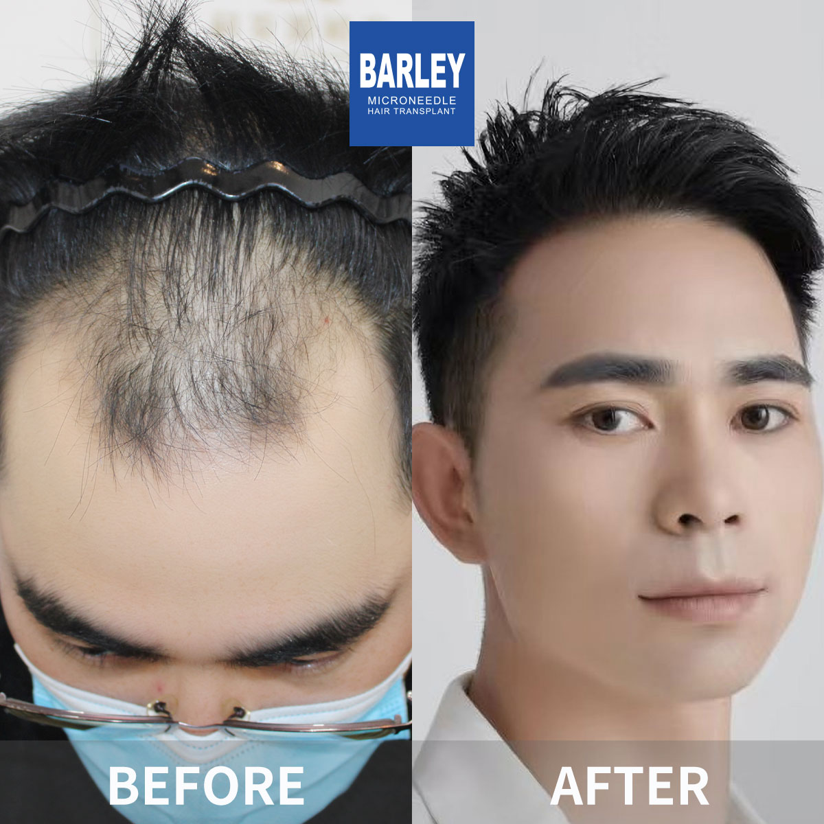 Hairline Transplant Result