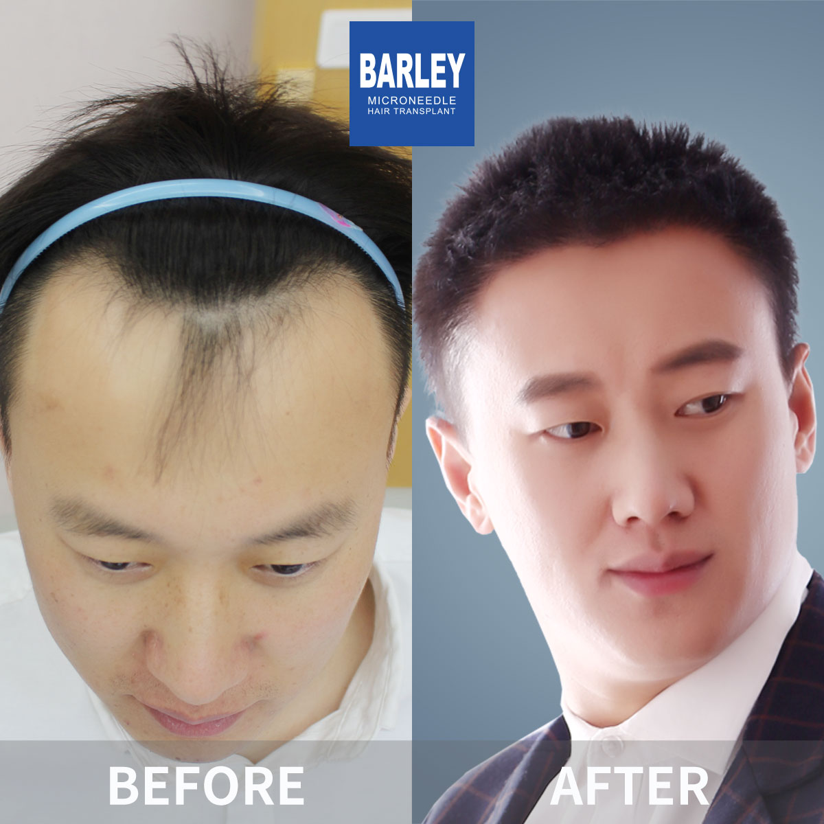 Hairline Transplant Result