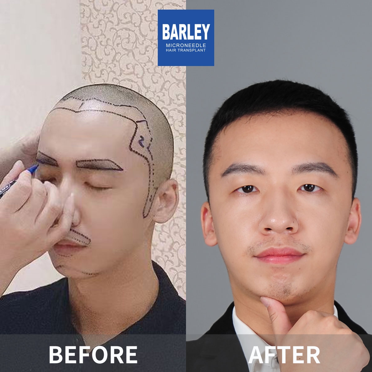 Hairline Transplant Result