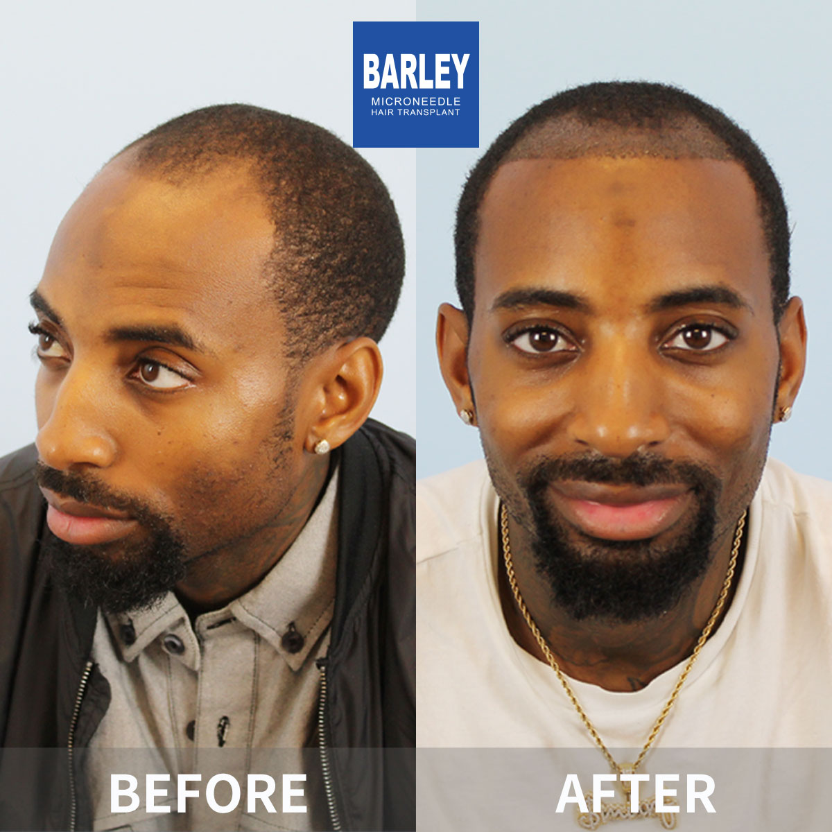 Hairline Transplant Result