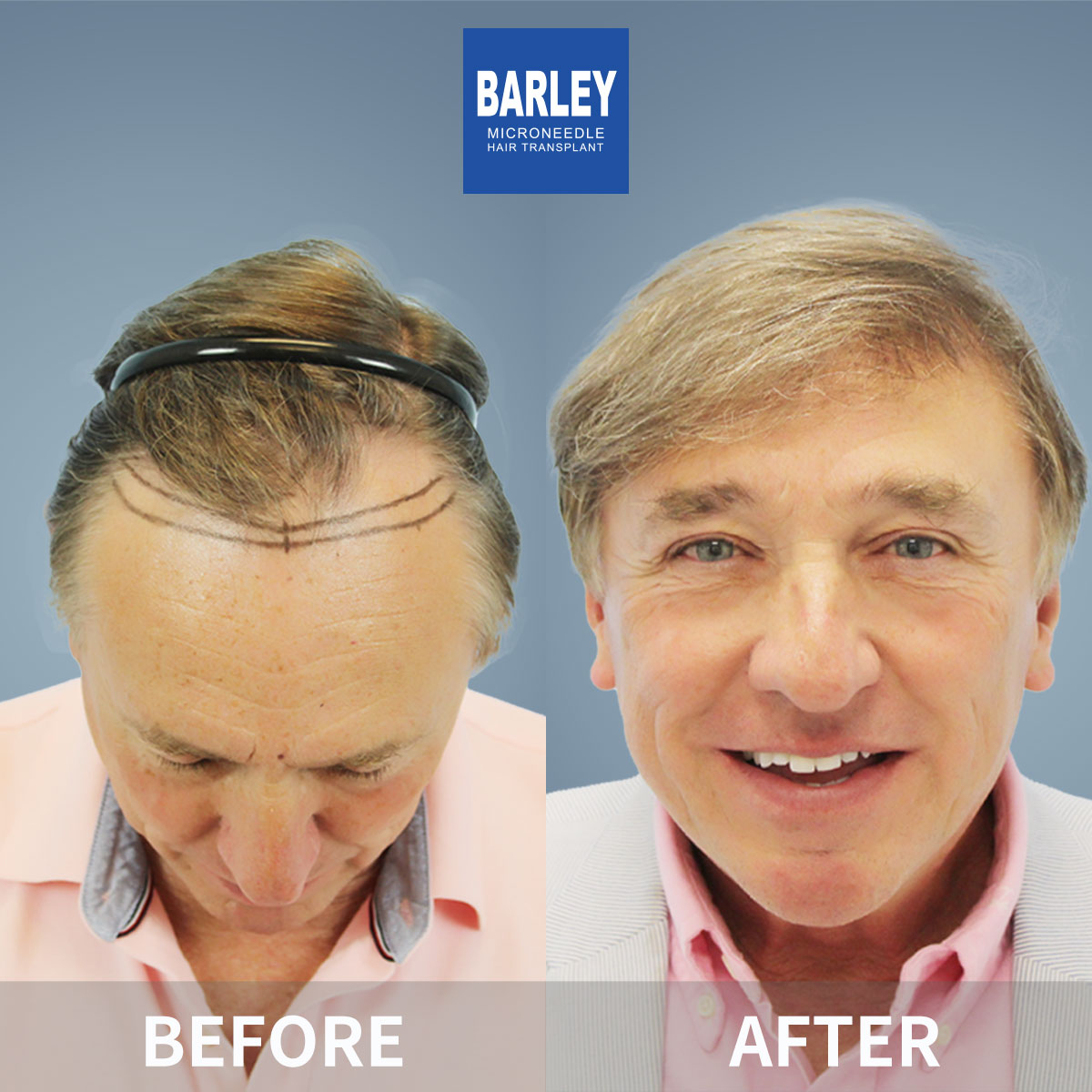 Hairline Transplant Result