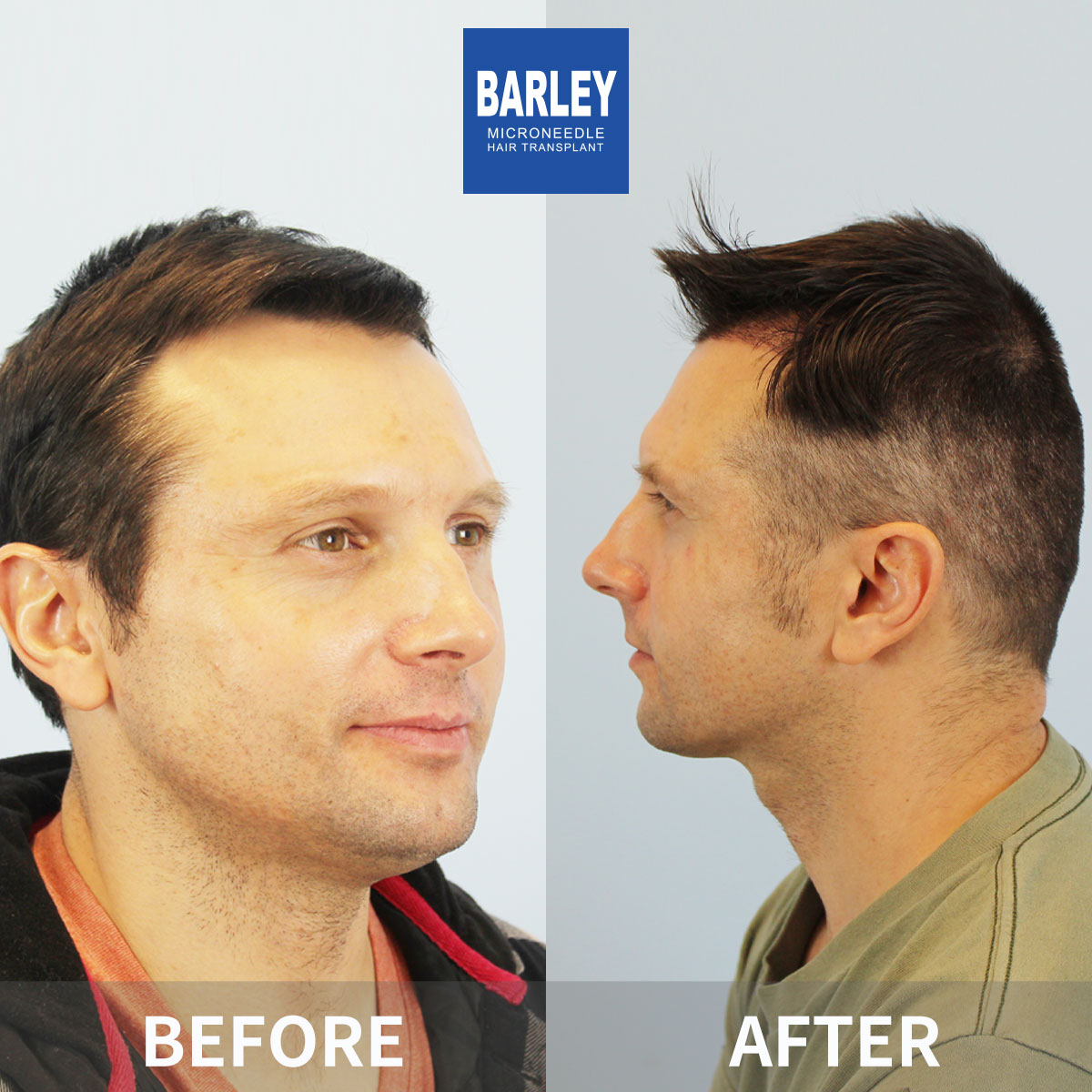Hairline Transplant Result