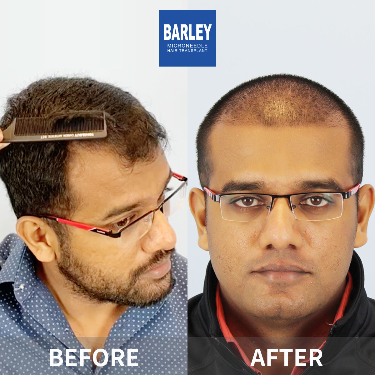 Hairline Transplant Result