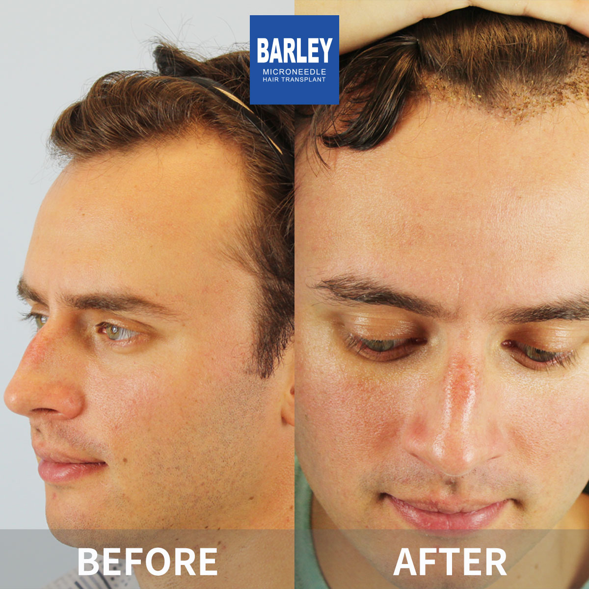 Hairline Transplant Result