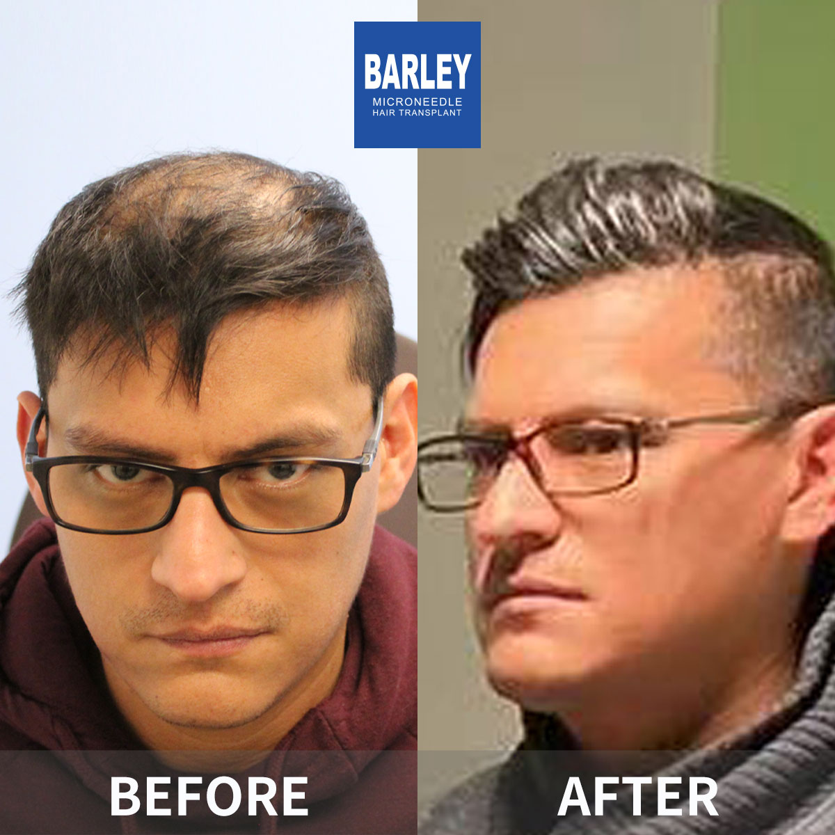 Hairline Transplant Result