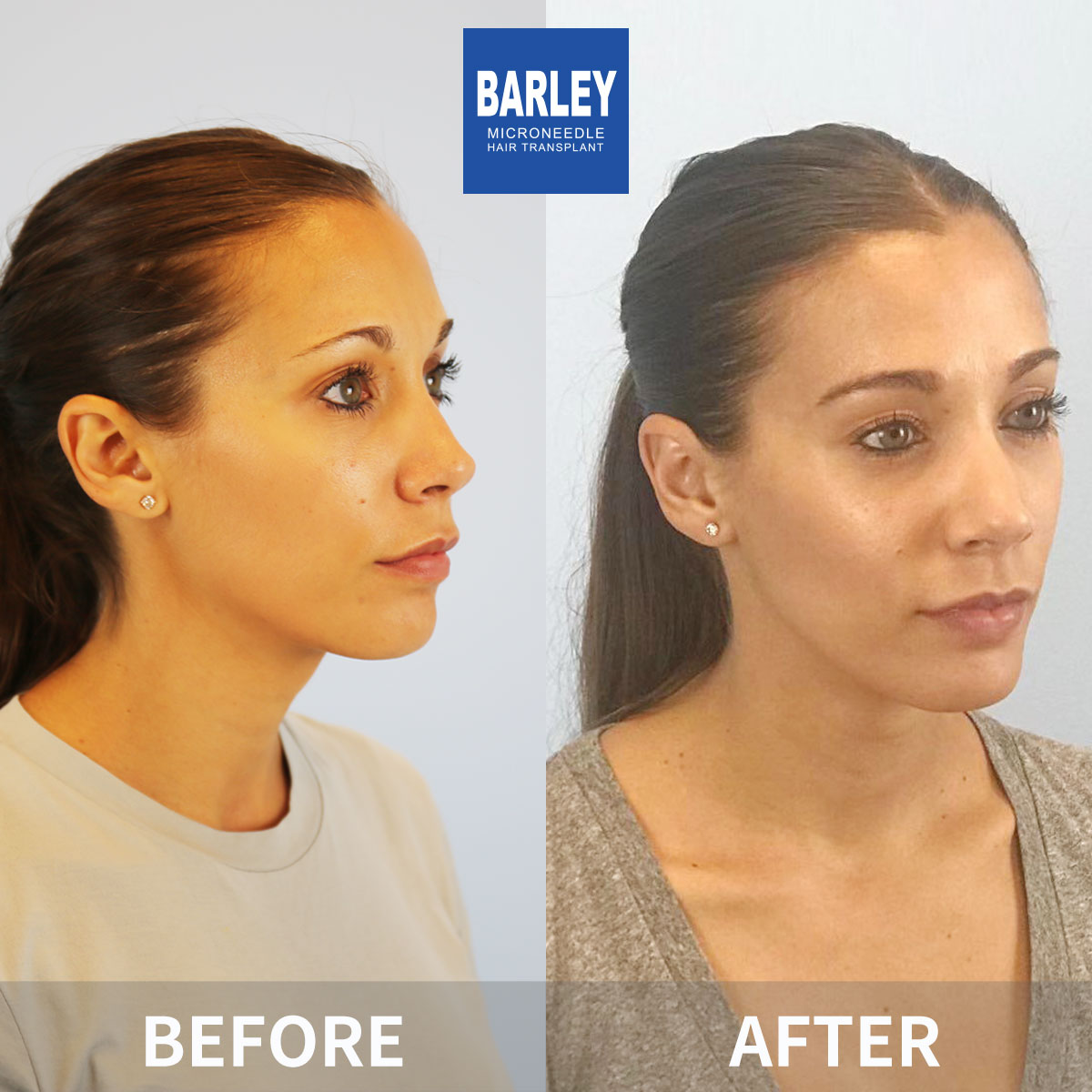 Women's Hairline Transplant Result