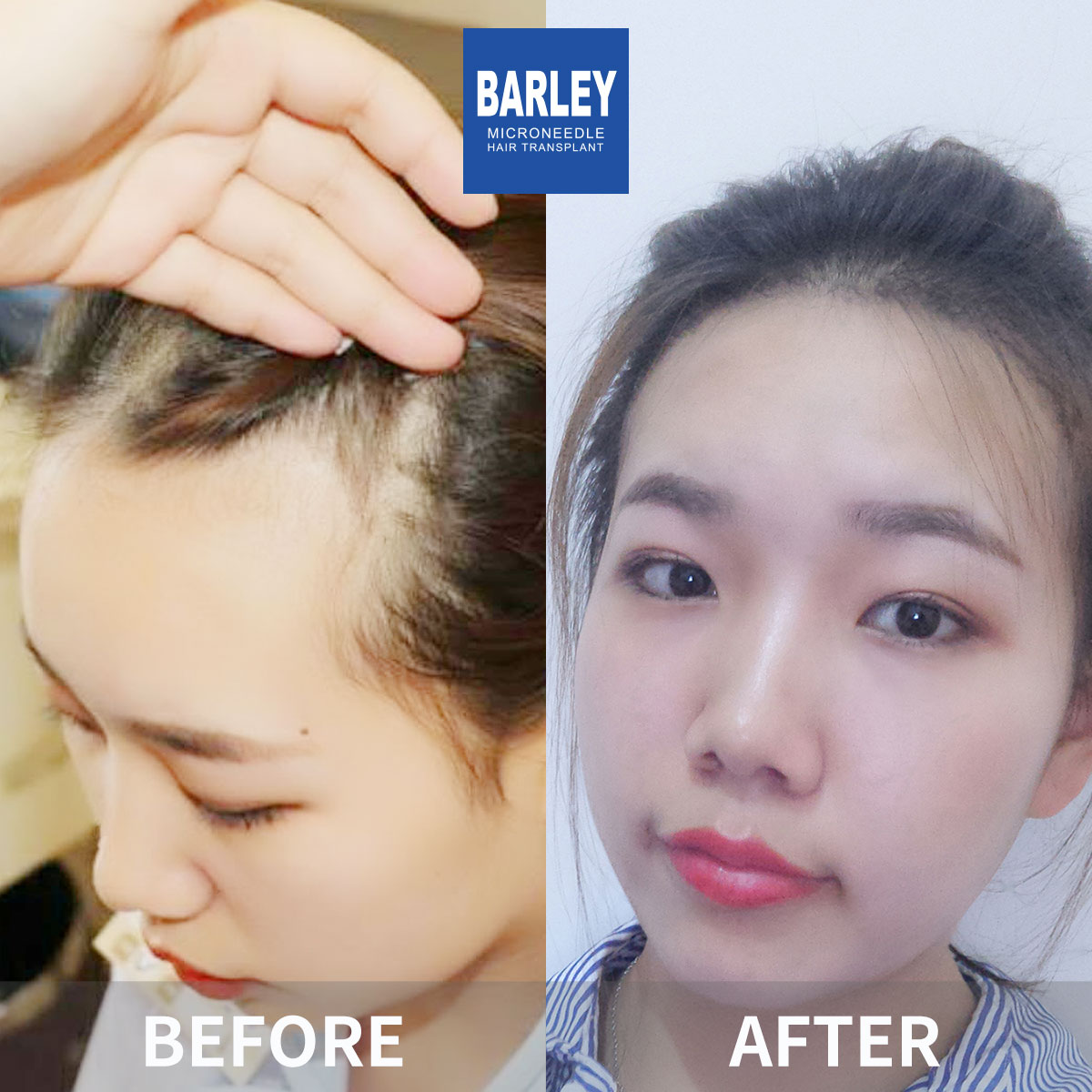 Women's Hairline Transplant Result
