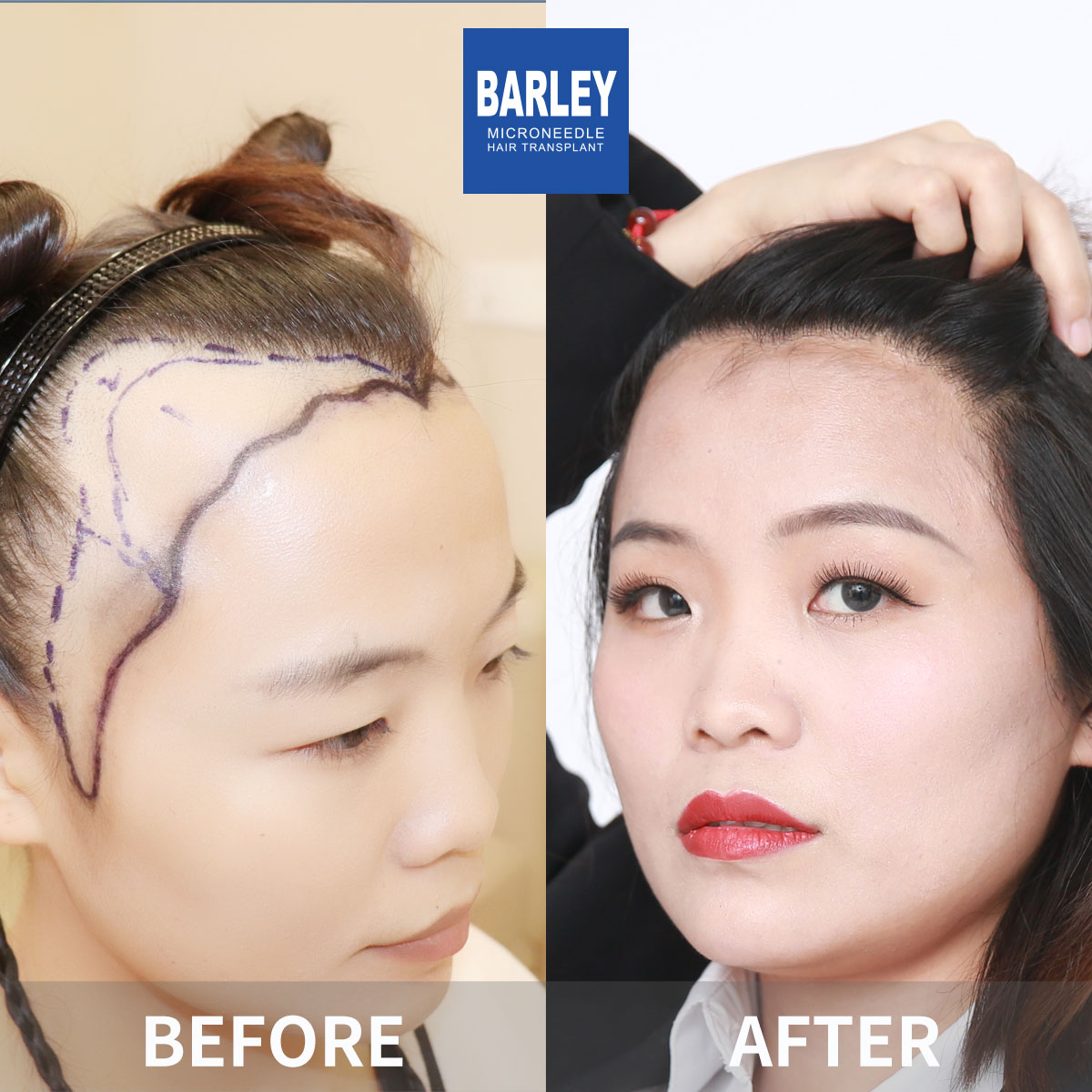 Women's Hairline Transplant Result