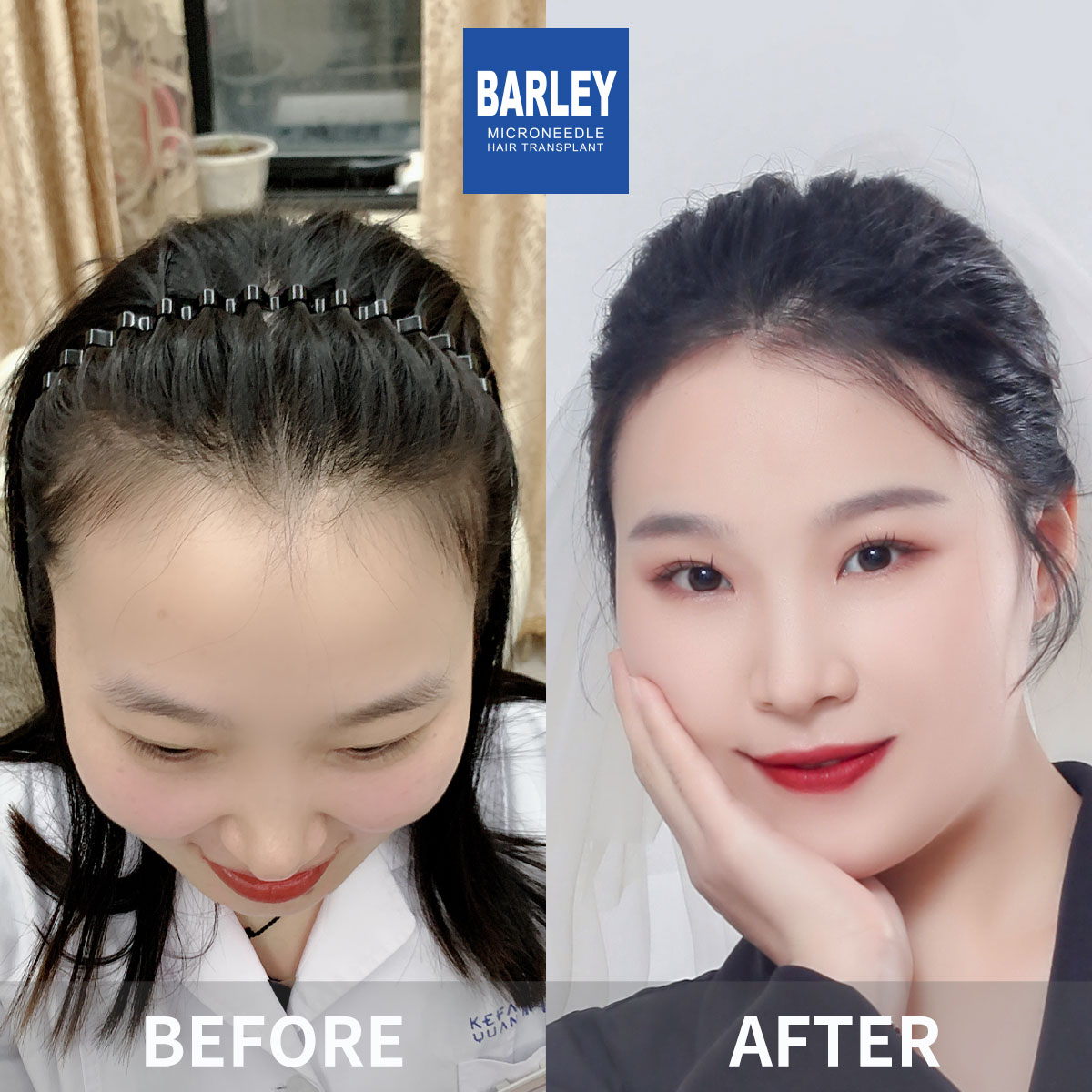 Women's Hairline Transplant Result
