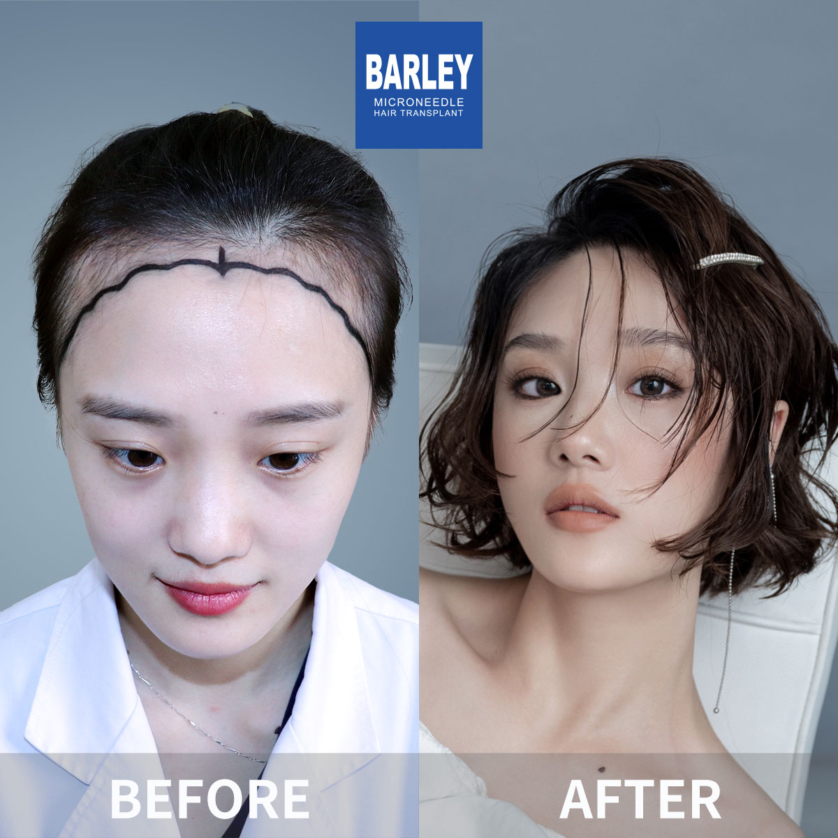 Women's Hairline Transplant Result