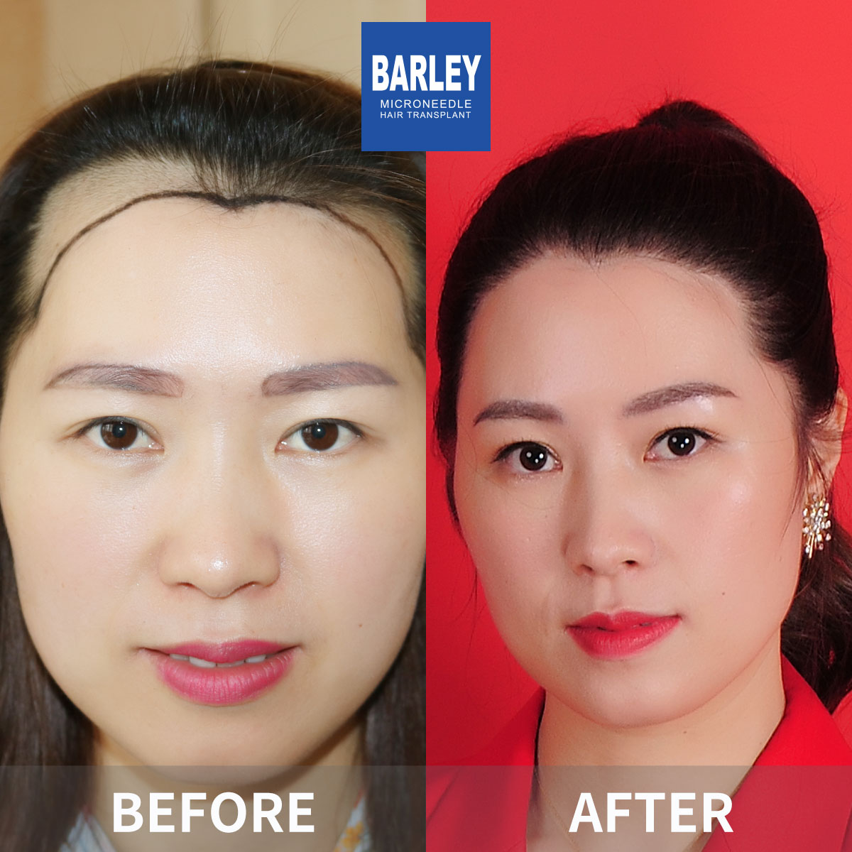 Women's Hairline Transplant Result