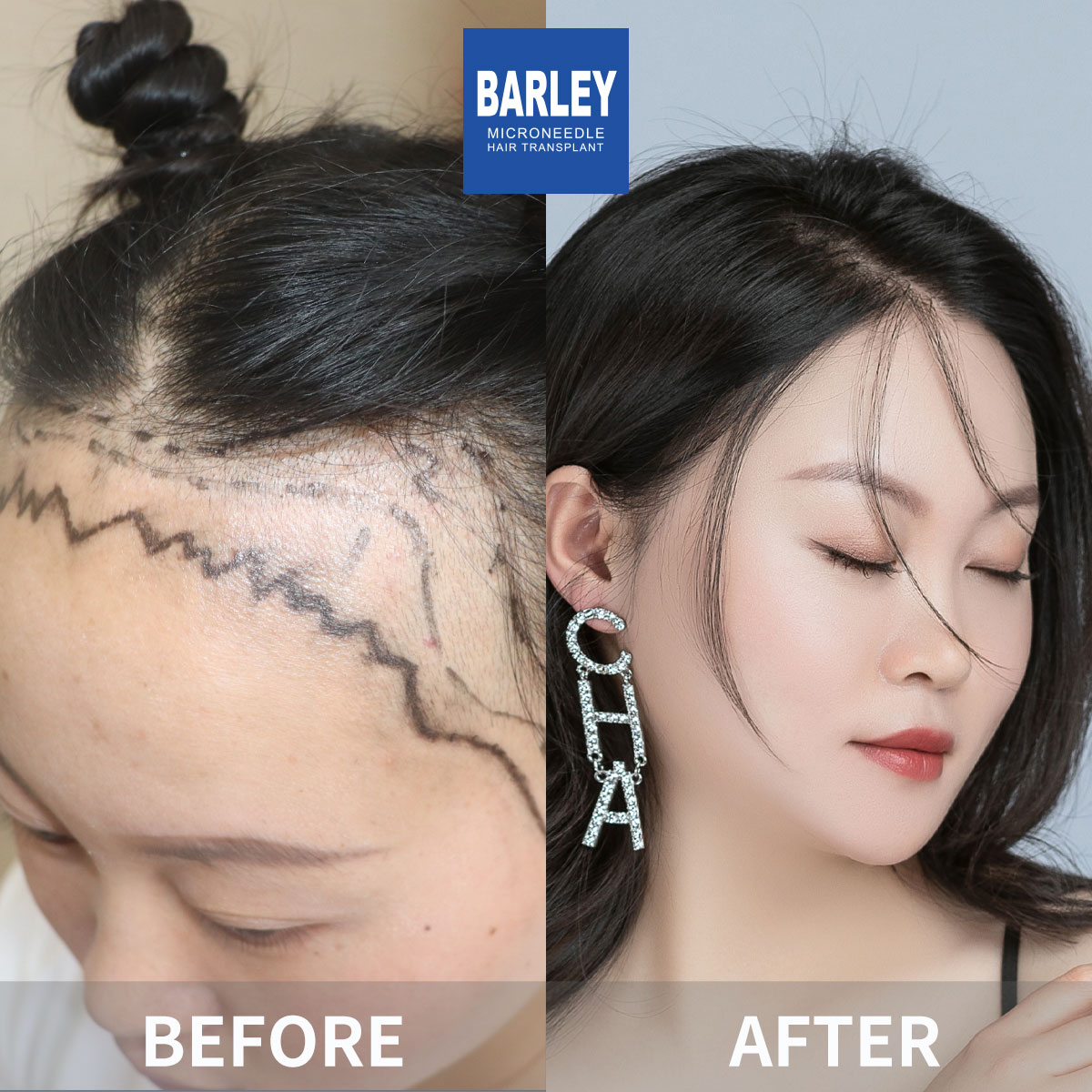 Women's Hairline Transplant Result