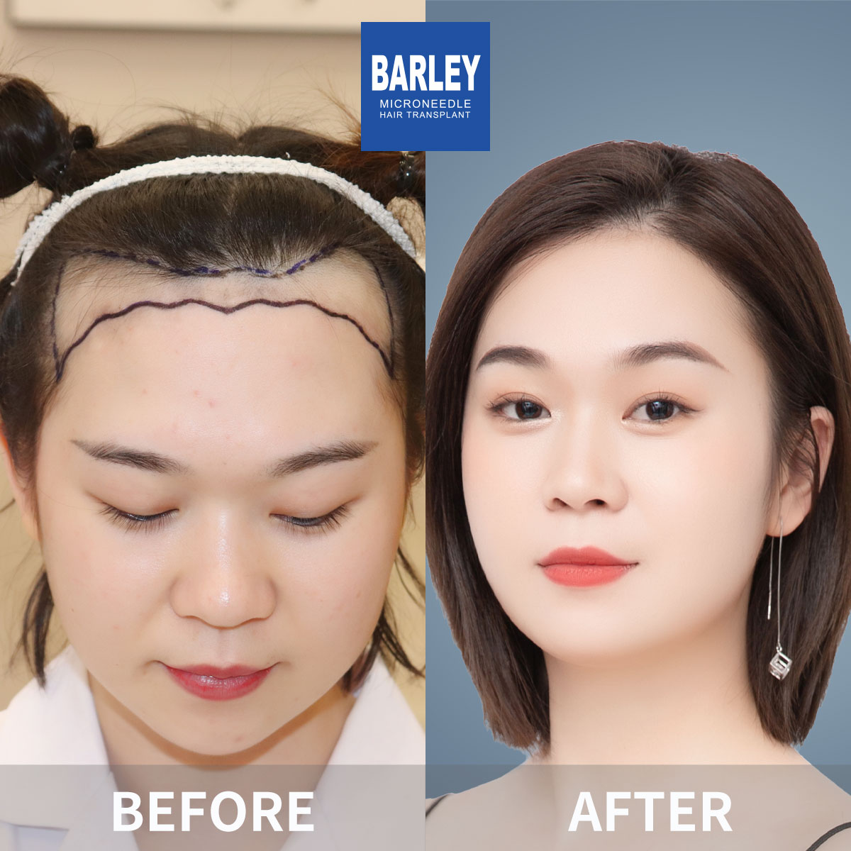 Women's Hairline Transplant Result