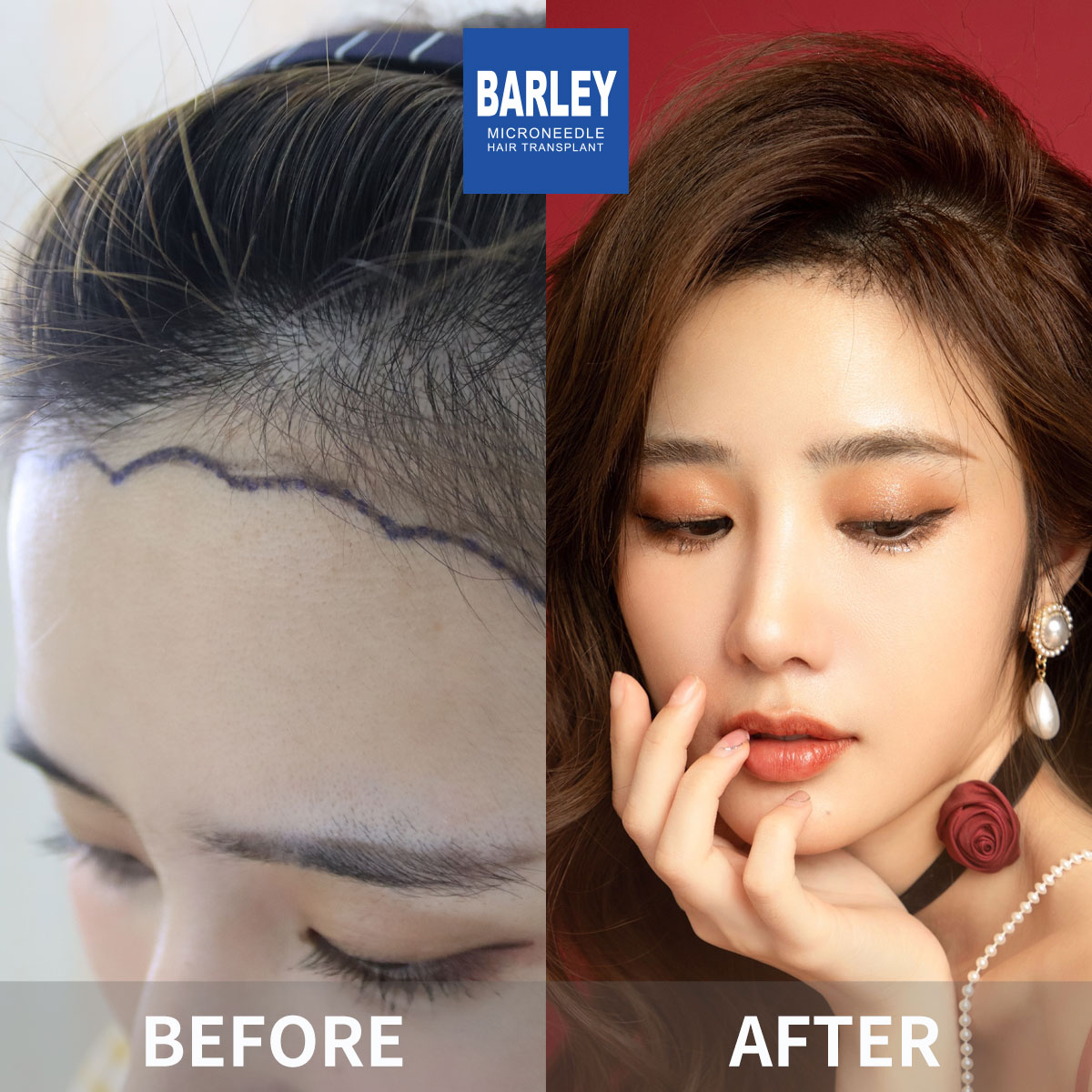 Women's Hairline Transplant Result