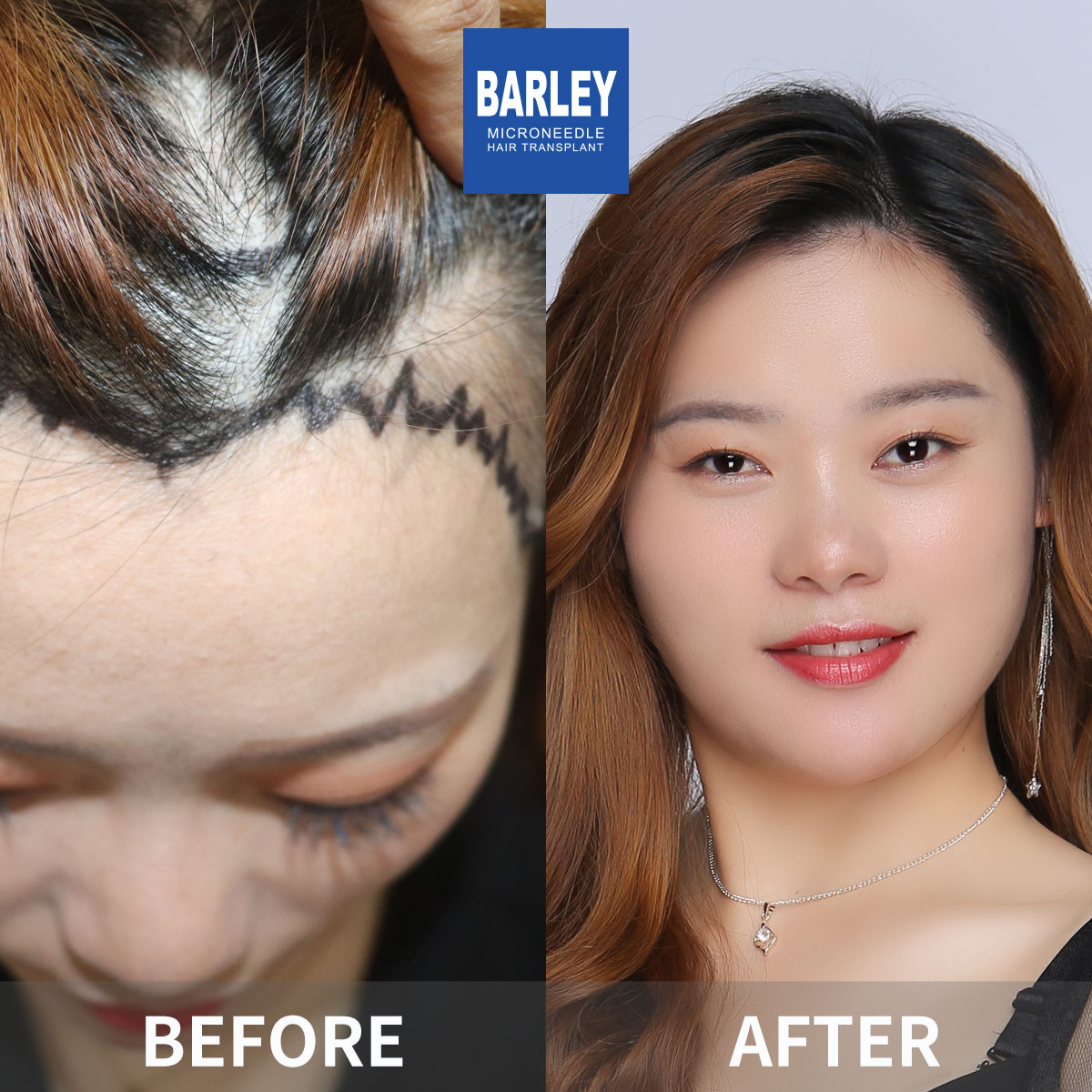 Women's Hairline Transplant Result
