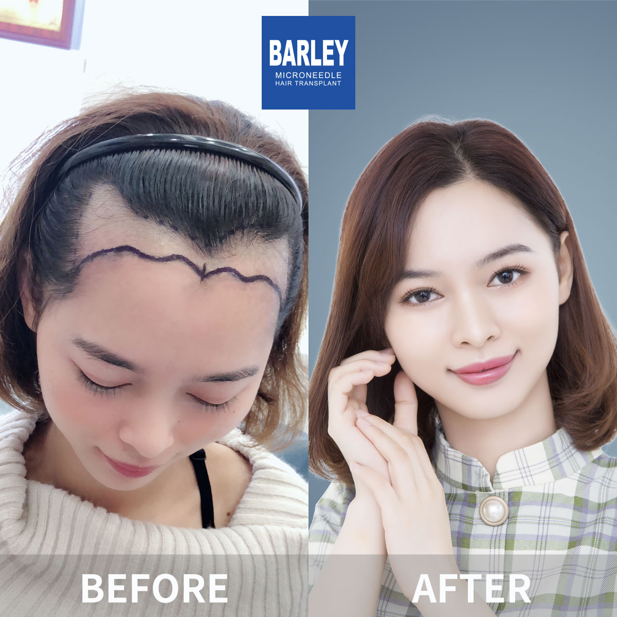 Women's Hairline Transplant Result