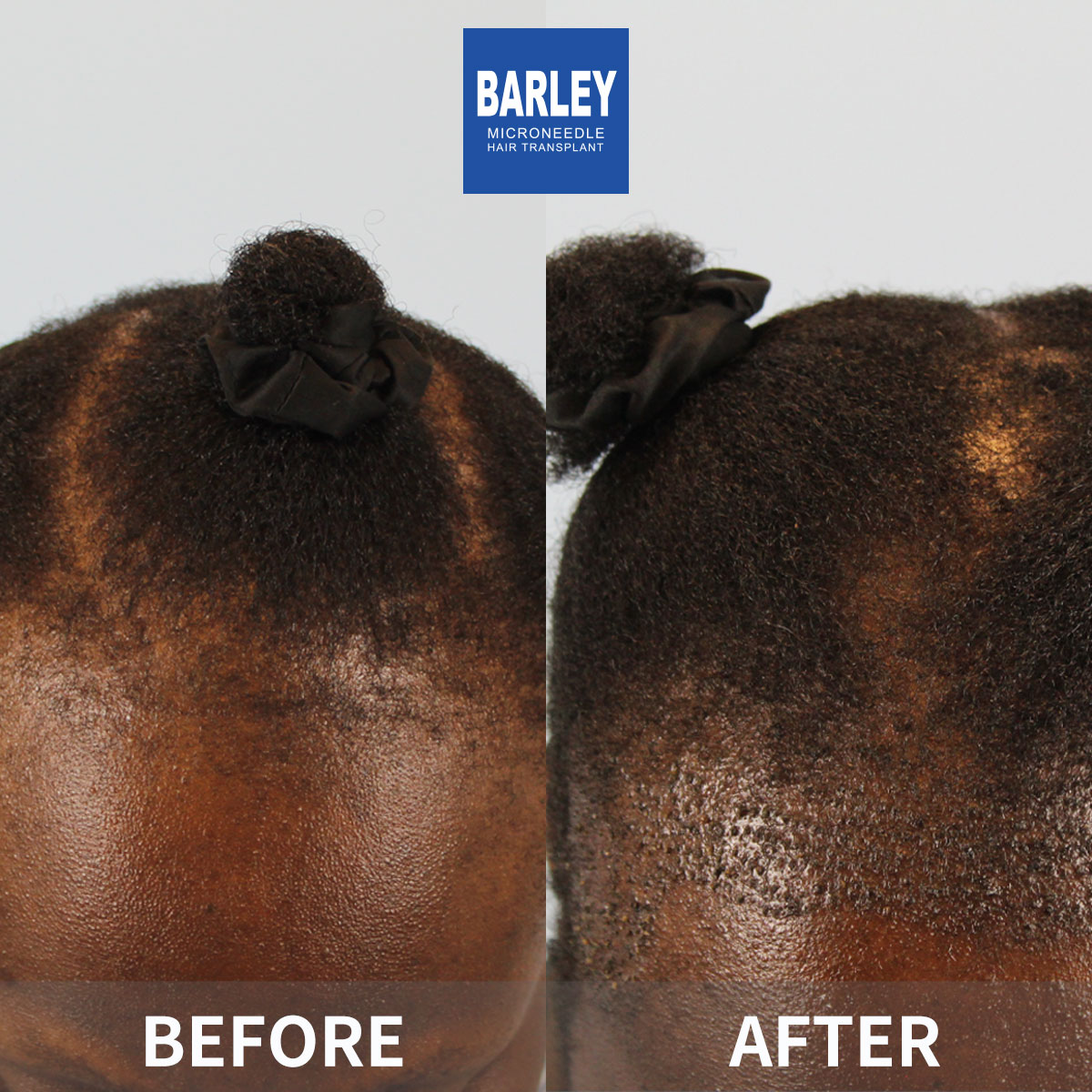 Women's Hairline Transplant Result