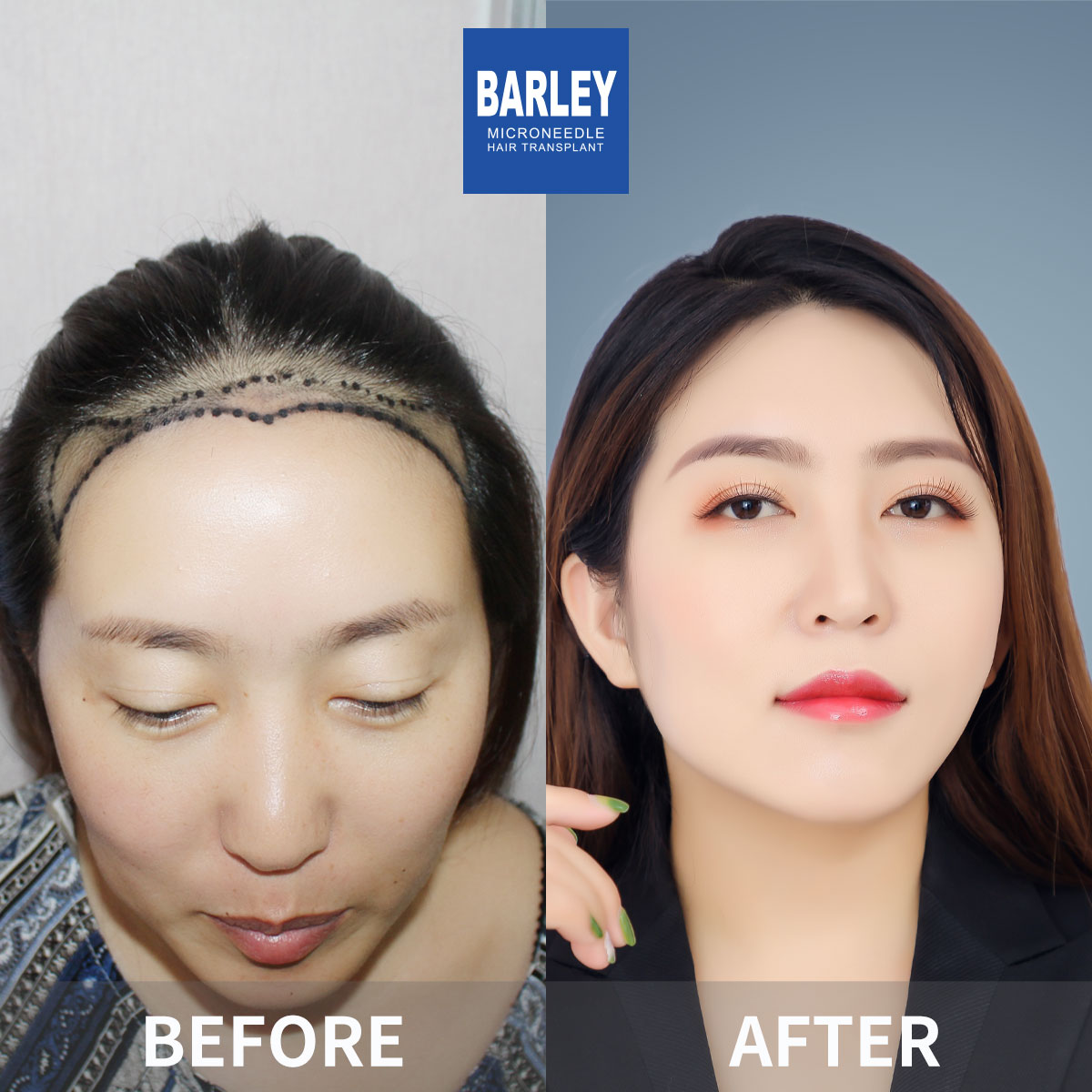 Women's Hairline Transplant Result
