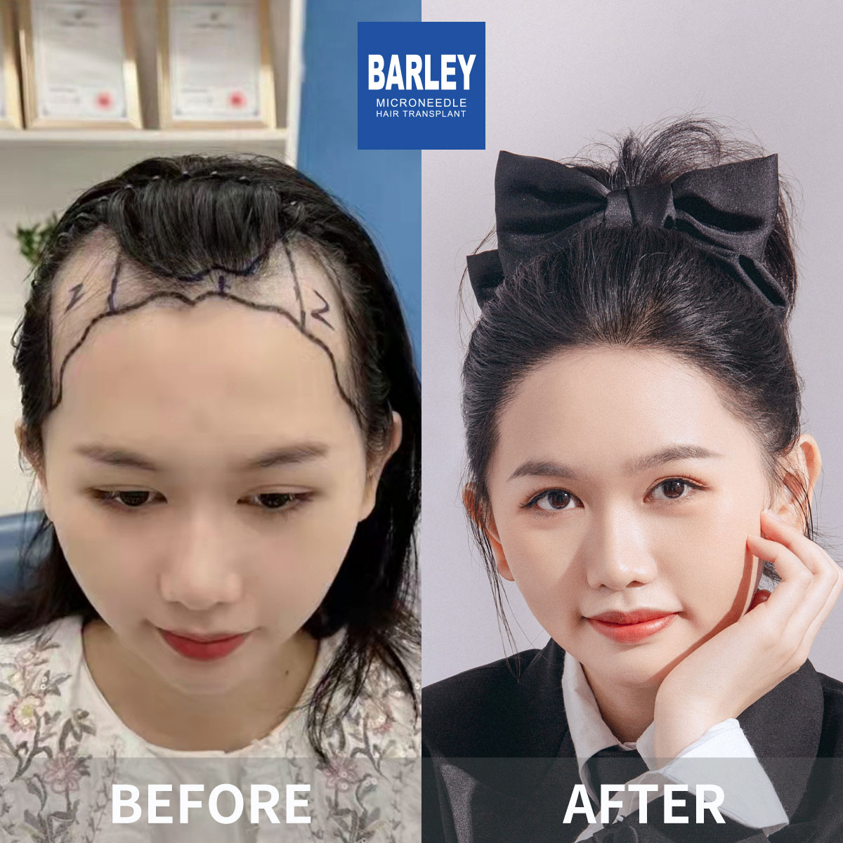 Women's Hairline Transplant Result