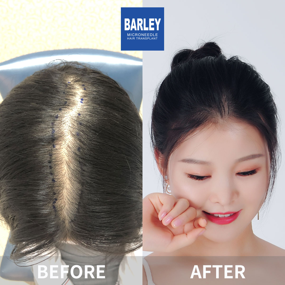 Female Hair Restoration