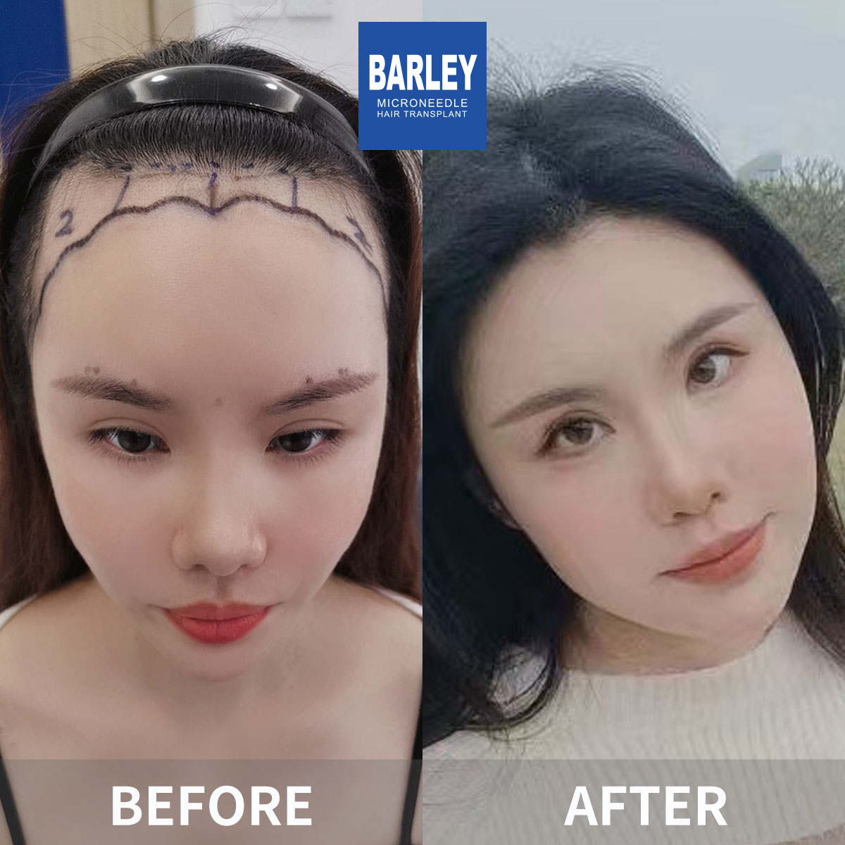 Women's Hairline Transplant Result