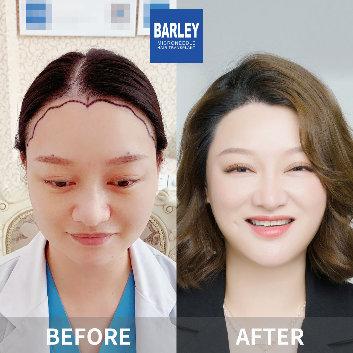 Women's Hairline Transplant Result