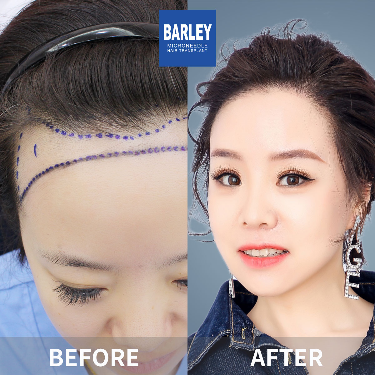 Women's Hairline Transplant Result