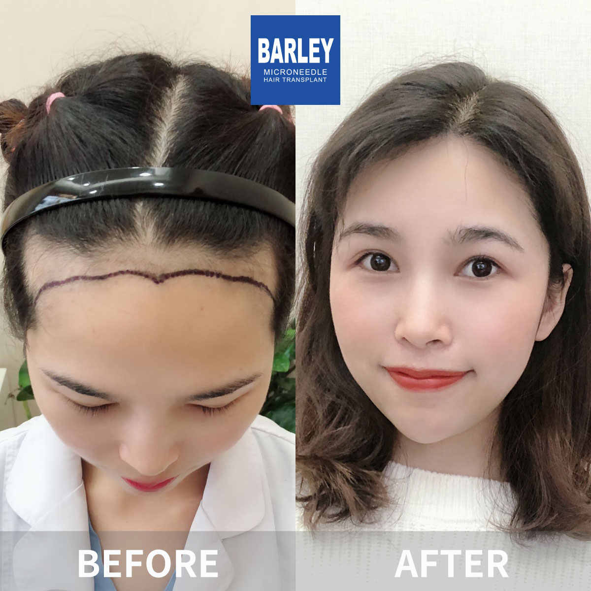 Women's Hairline Transplant Result