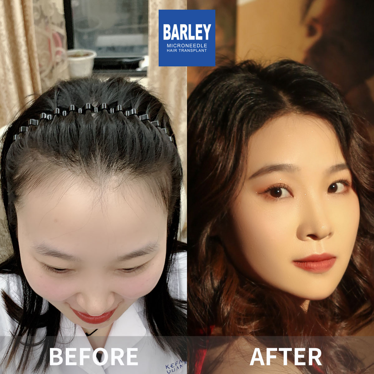 Women's Hairline Transplant Result