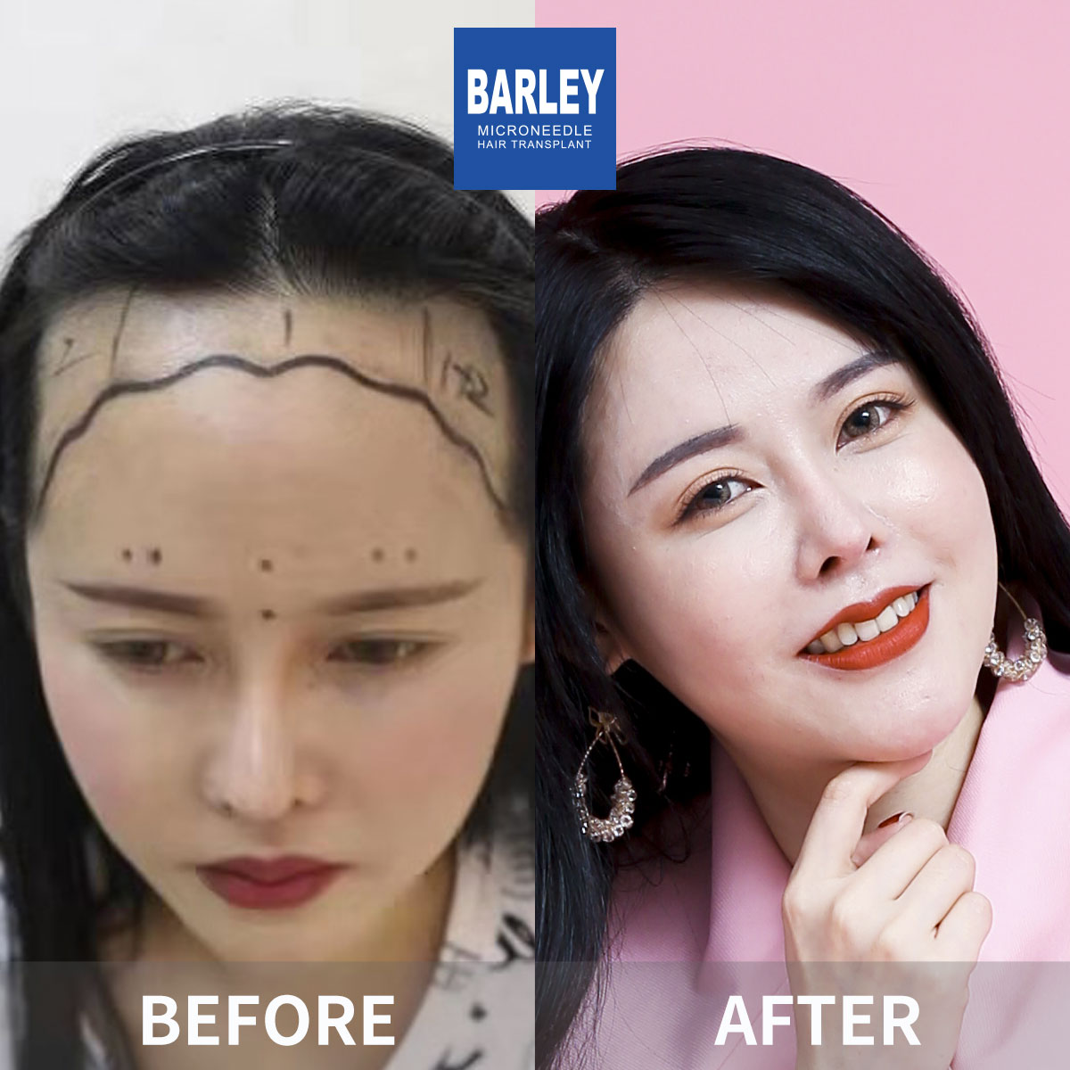 Women's Hairline Transplant Result