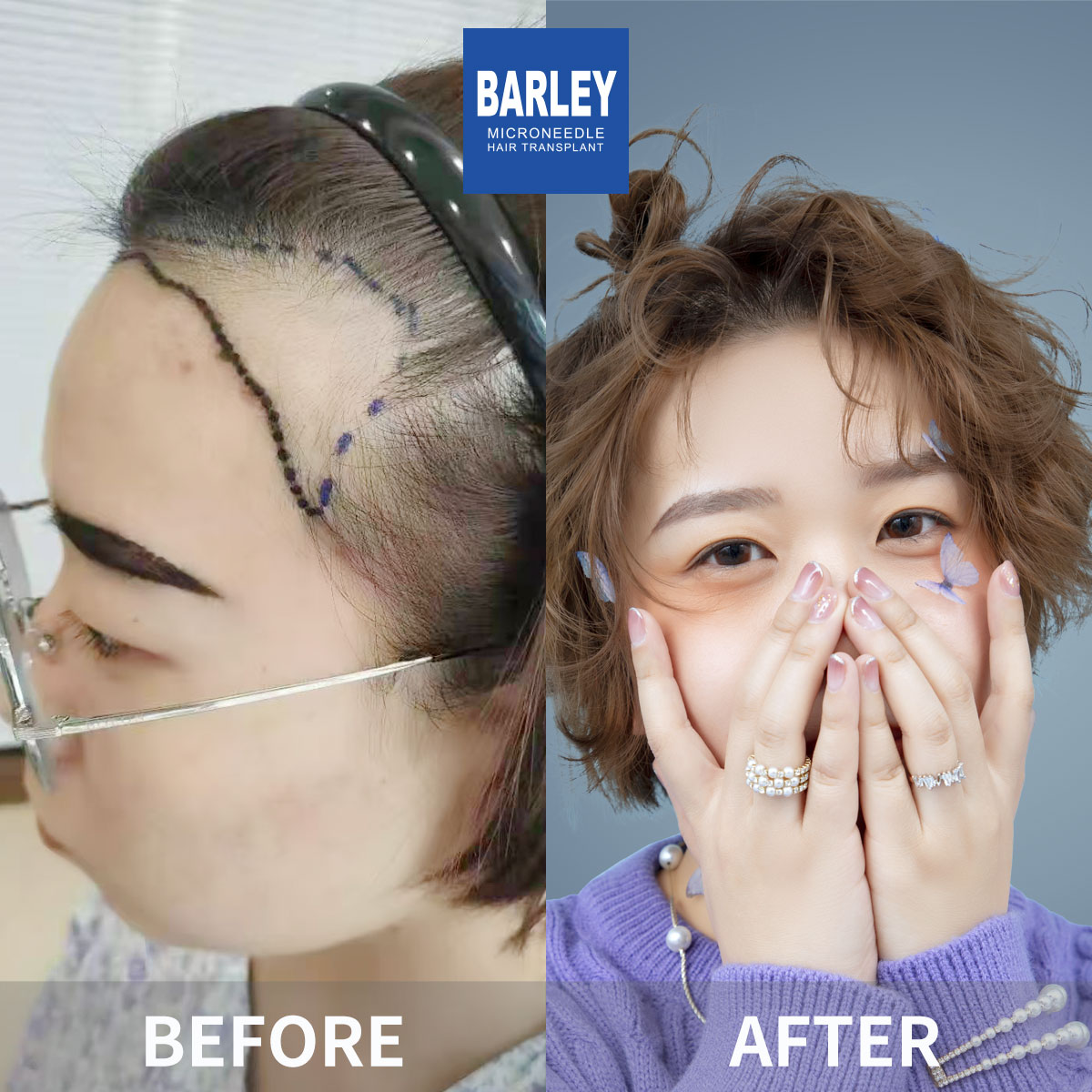 Women's Hairline Transplant Result