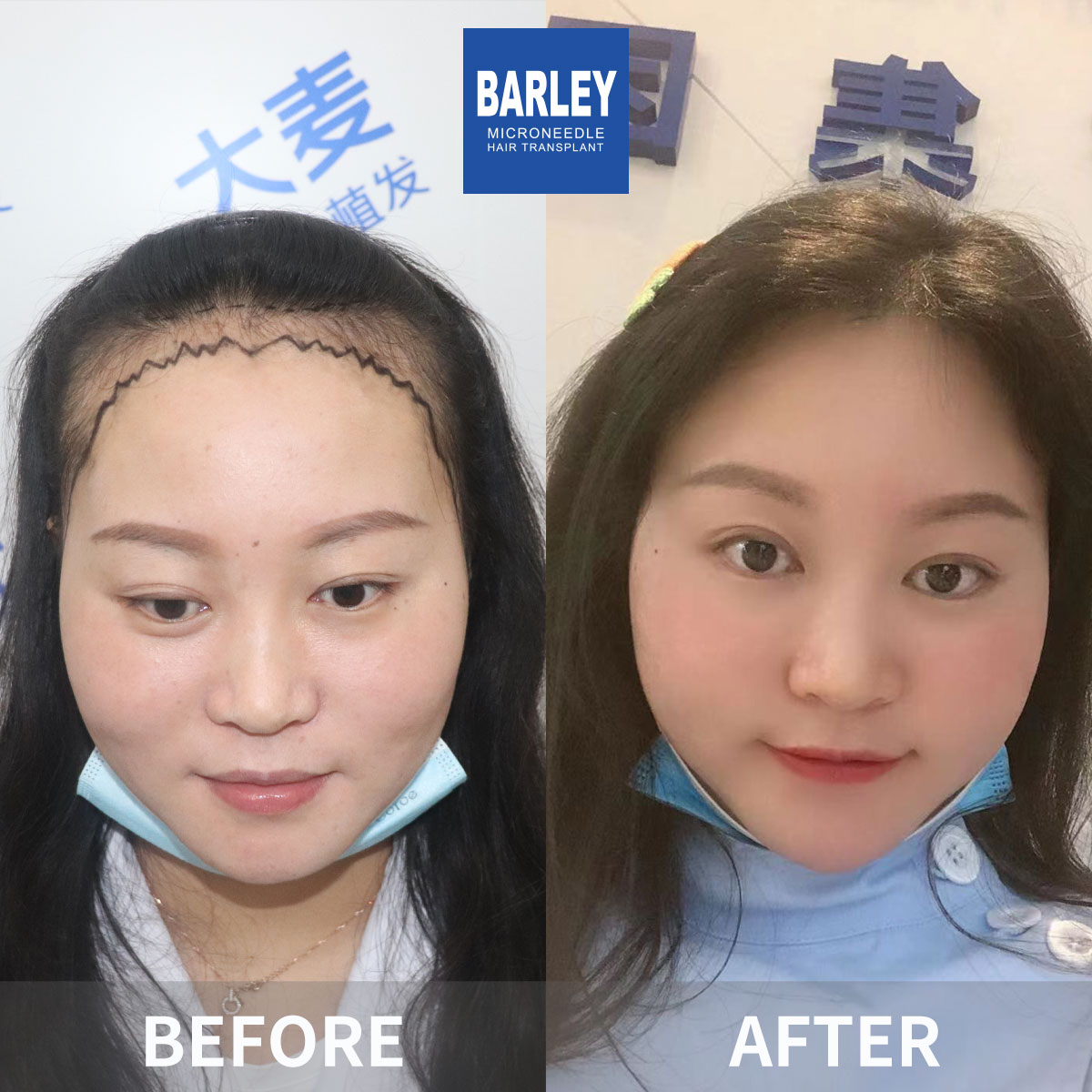 Women's Hairline Transplant Result