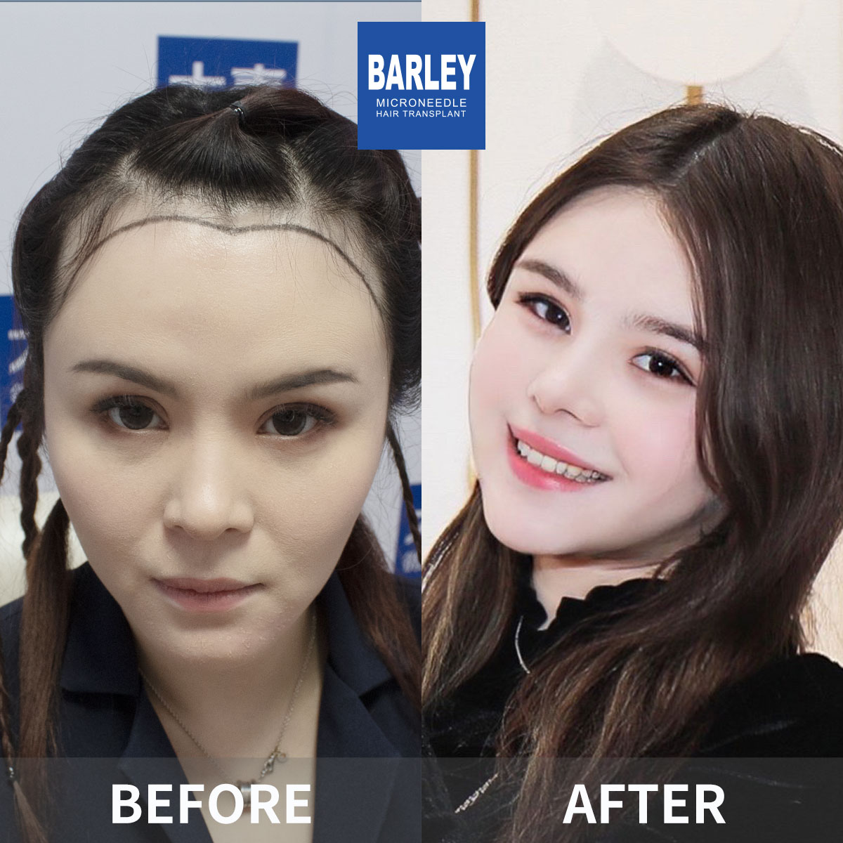 Women's Hairline Transplant Result