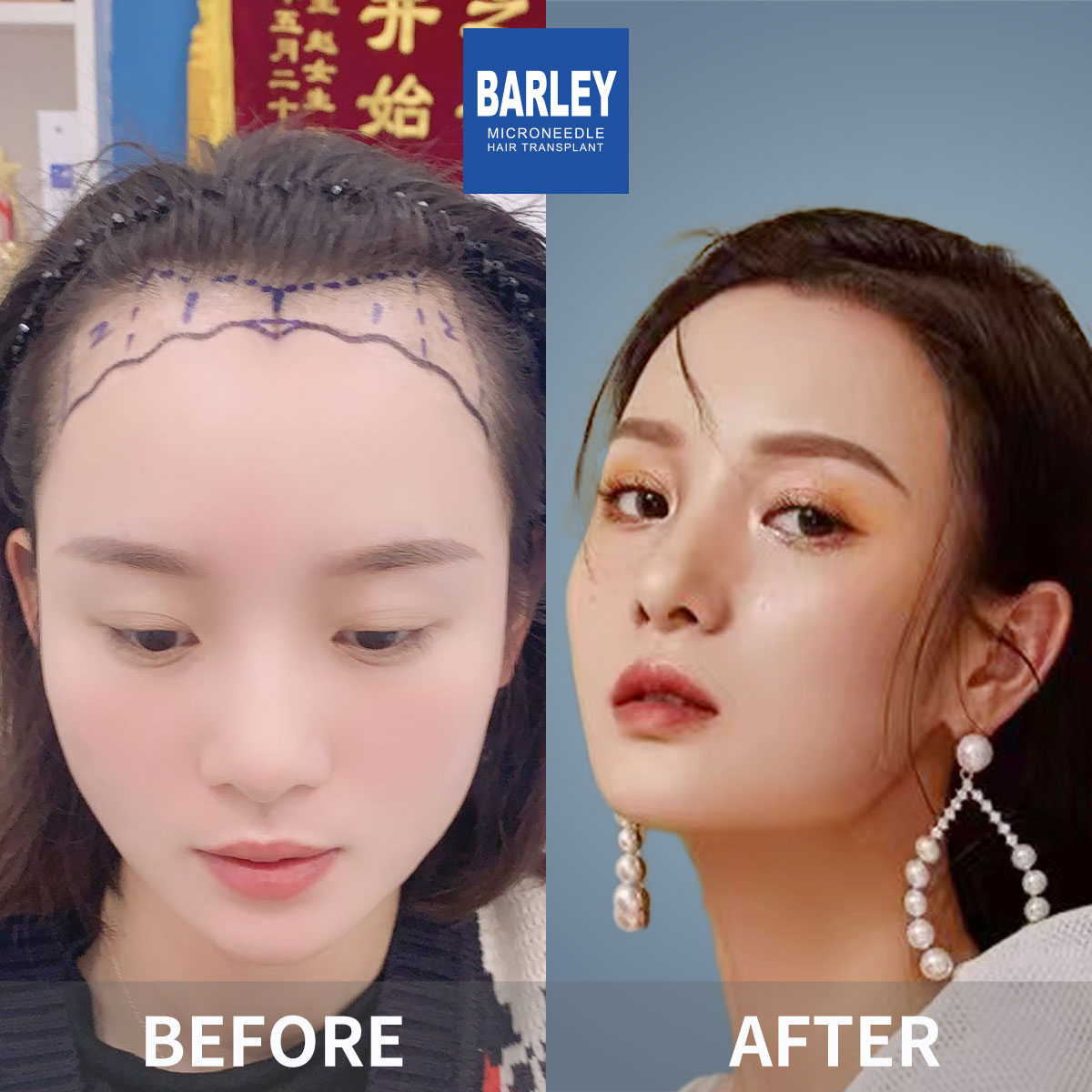 Women's Hairline Transplant Result