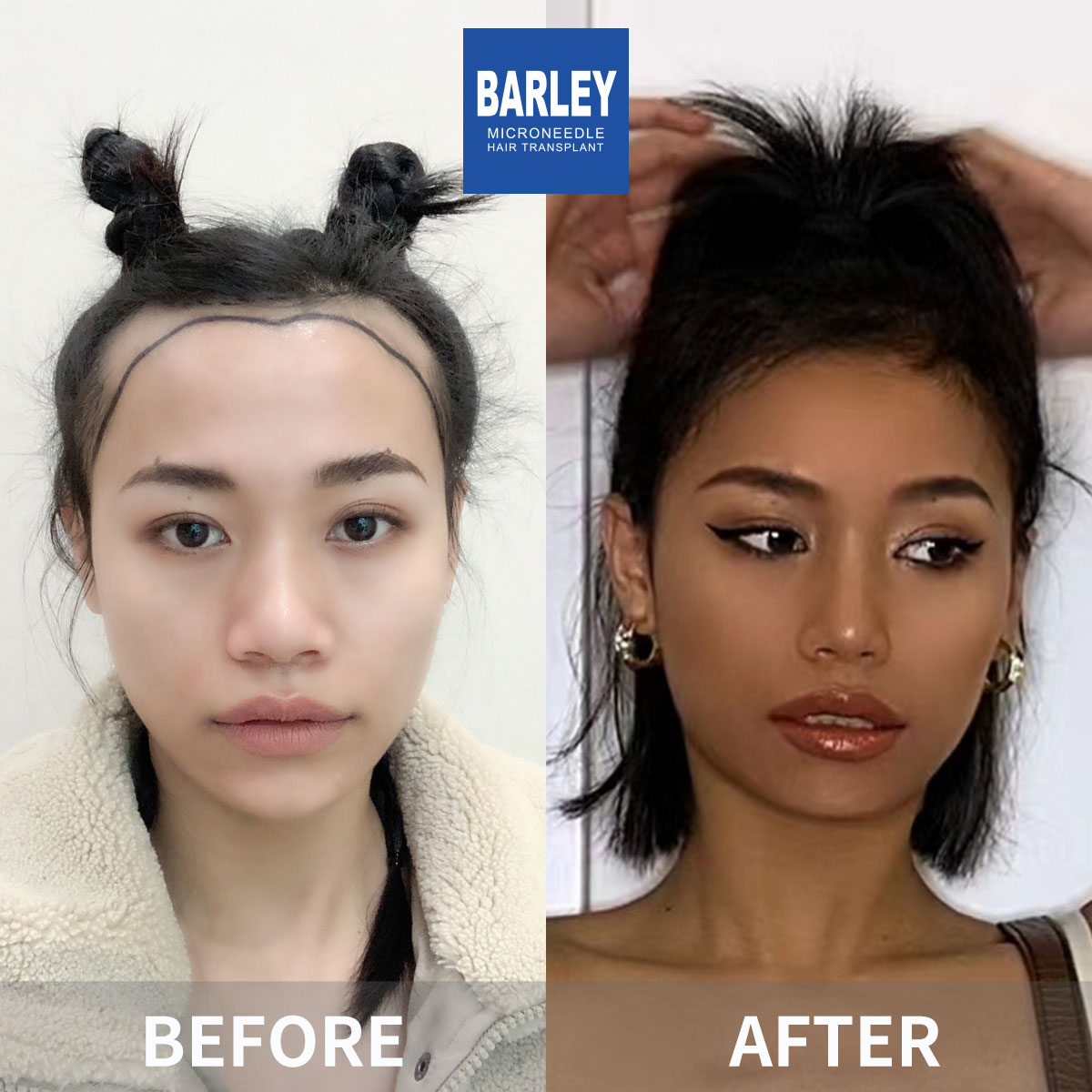 Women's Hairline Transplant Result