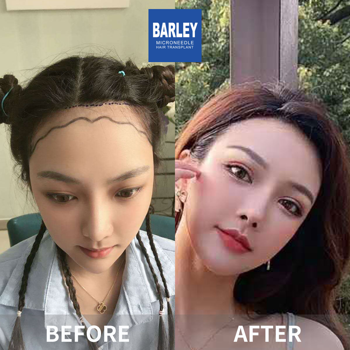 Women's Hairline Transplant Result
