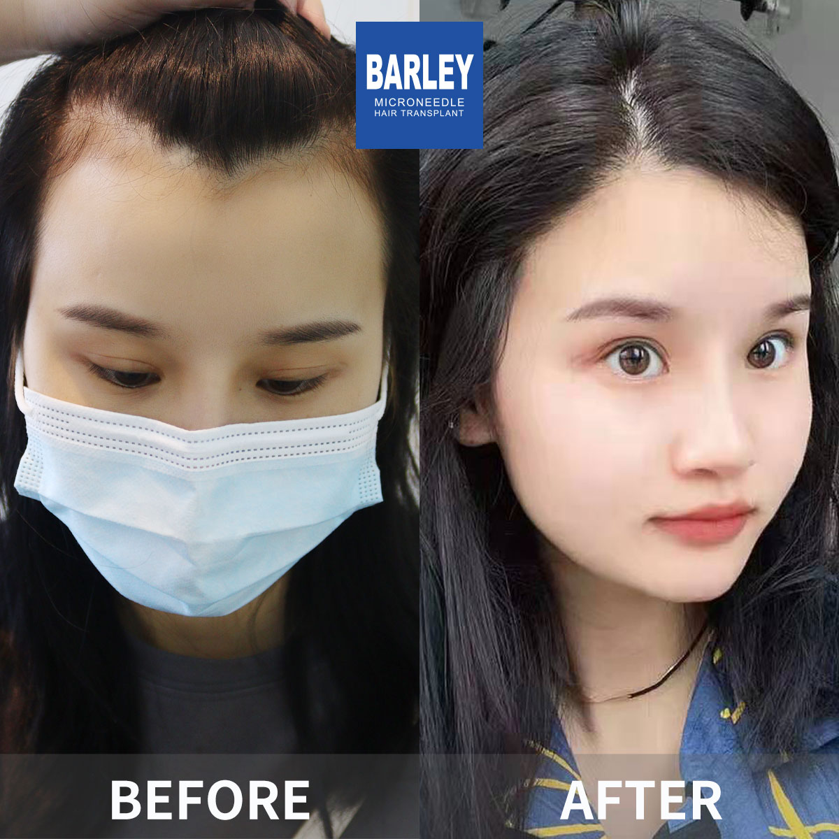 Women's Hairline Transplant Result